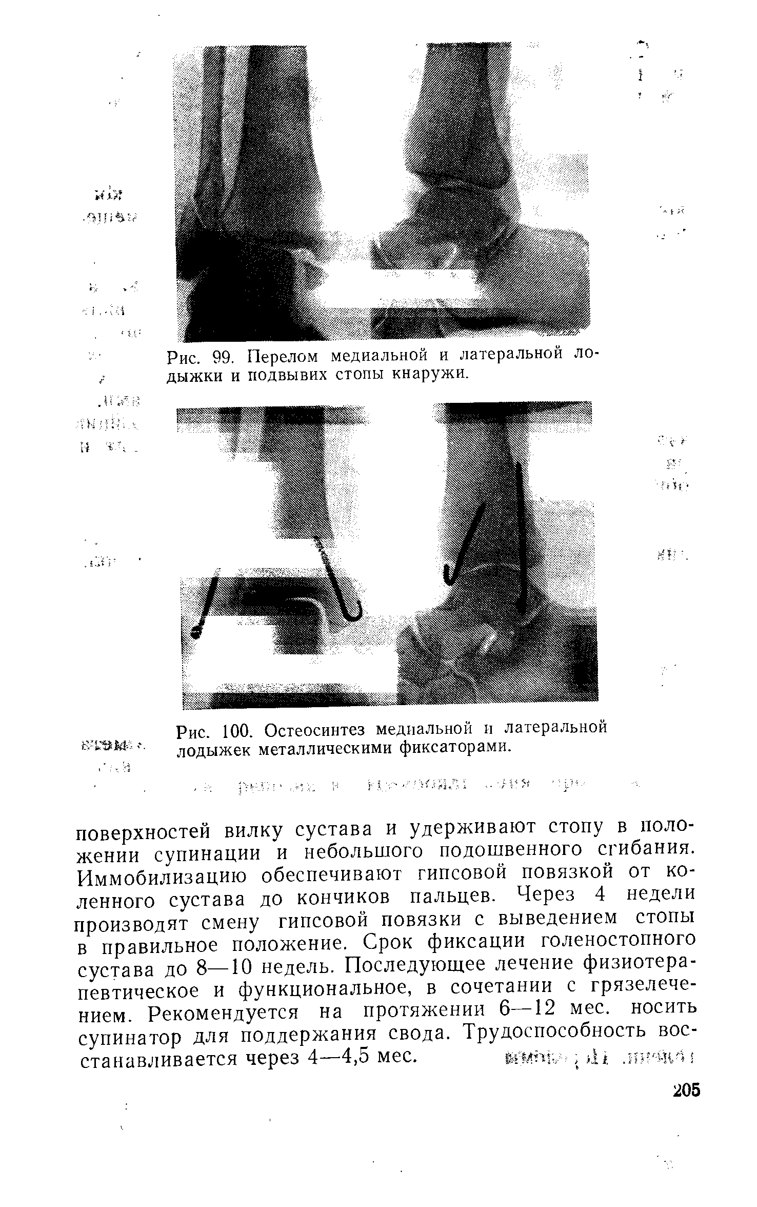 Рис. 100. Остеосинтез медиальной и латеральной лодыжек металлическими фиксаторами.