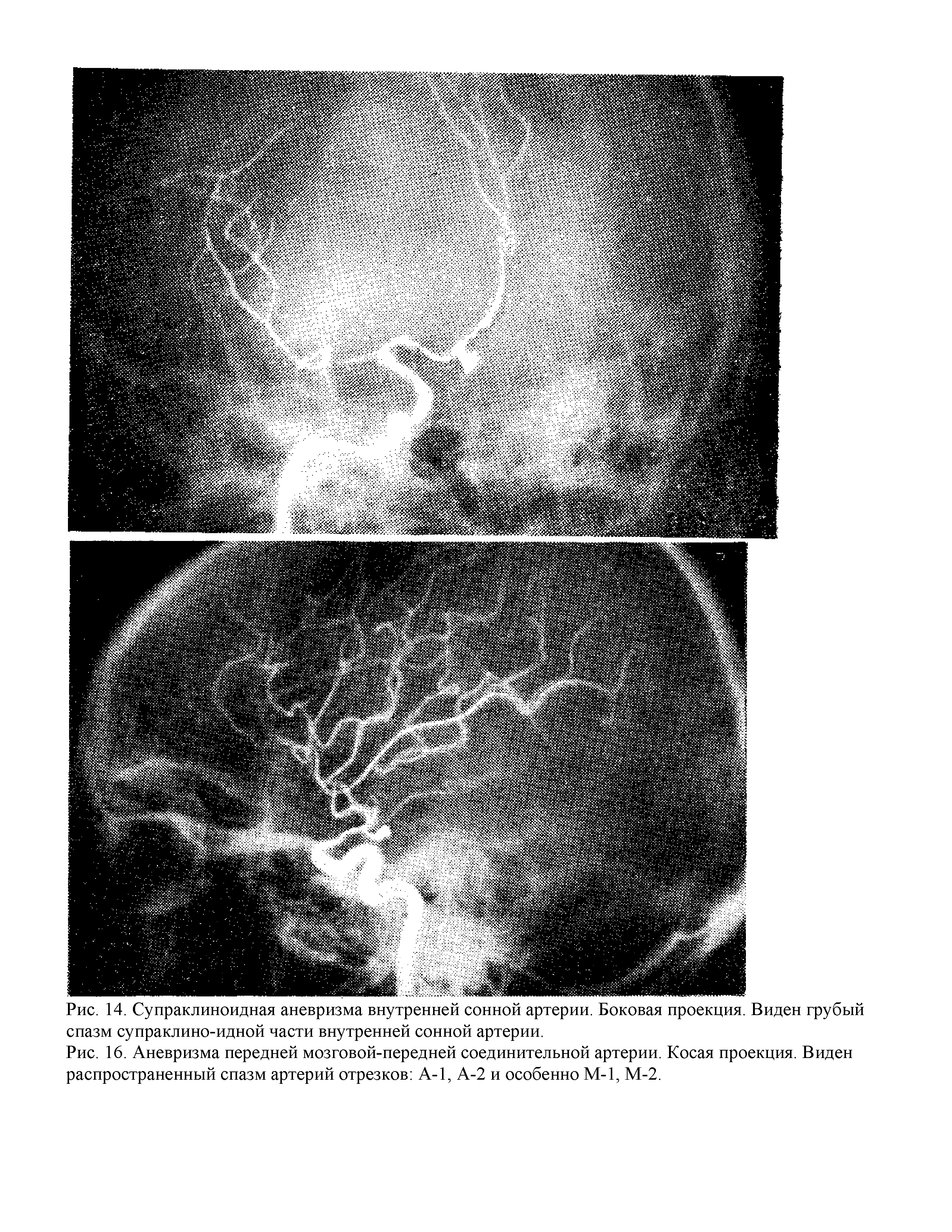 Рис. 16. Аневризма передней мозговой-передней соединительной артерии. Косая проекция. Виден распространенный спазм артерий отрезков А-1, А-2 и особенно М-1, М-2.