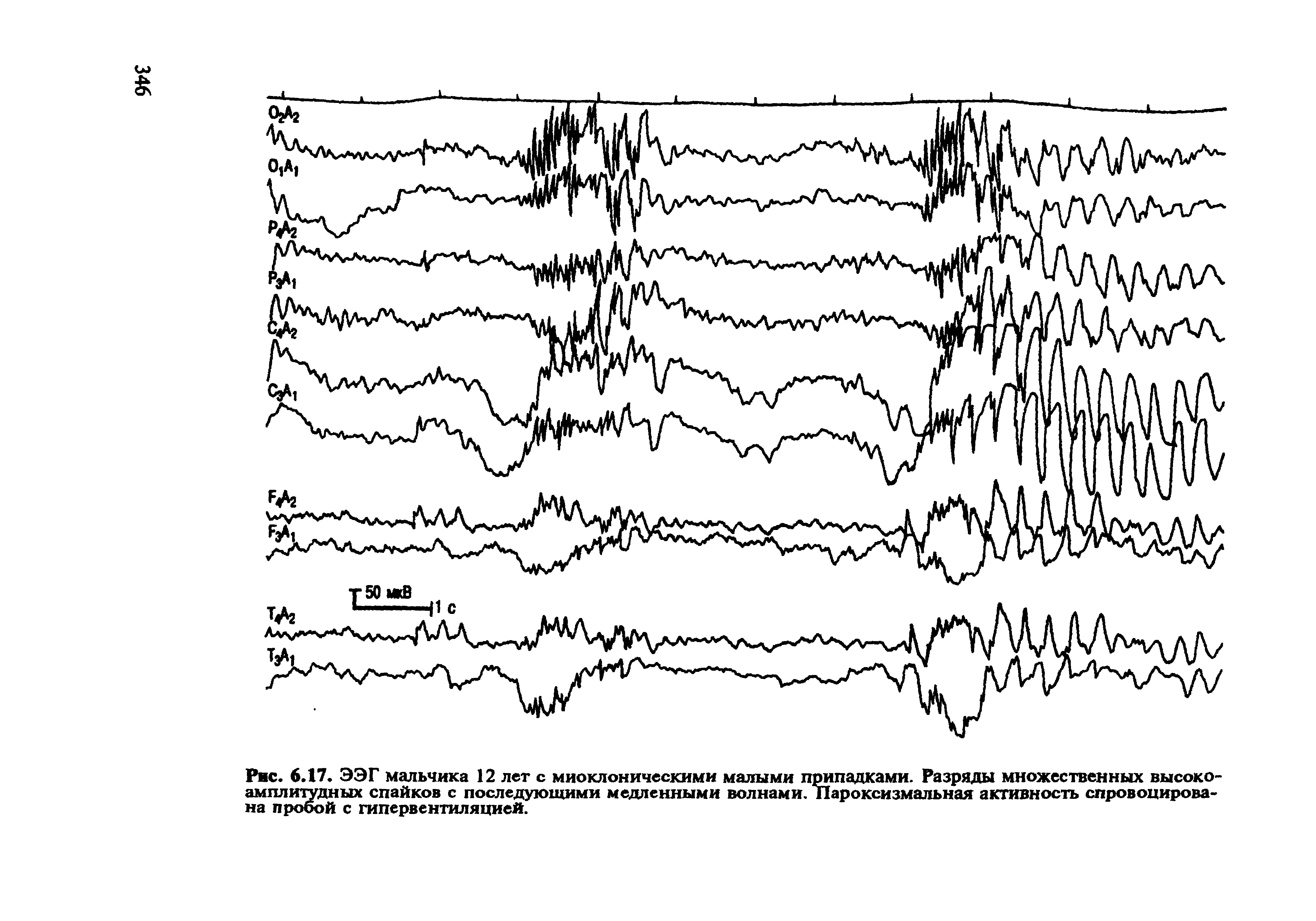 Рис. 6.17, ЭЭГ мальчика 12 лет с миоклоническими малыми припадками. Разряды множественных высокоамплитудных спайков с последующими медленными волнами. Пароксизмальная активность спровоцирована пробой с гипервентиляцией.