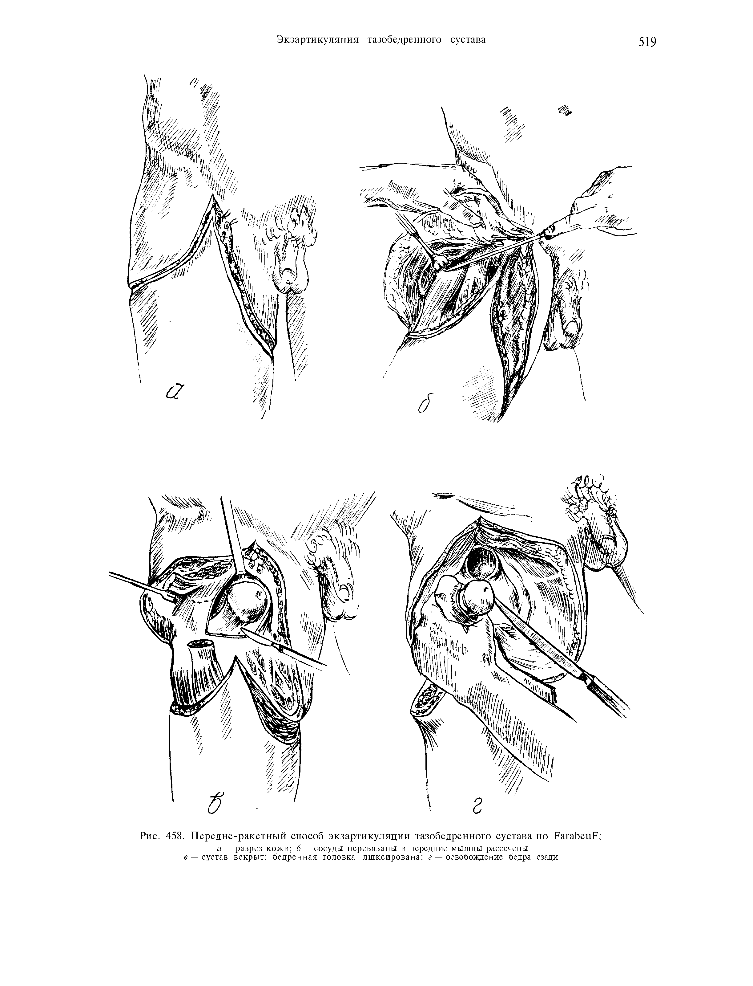 Рис. 458. Передне-ракетный способ экзартикуляции тазобедренного сустава по РагаЬеиР ...