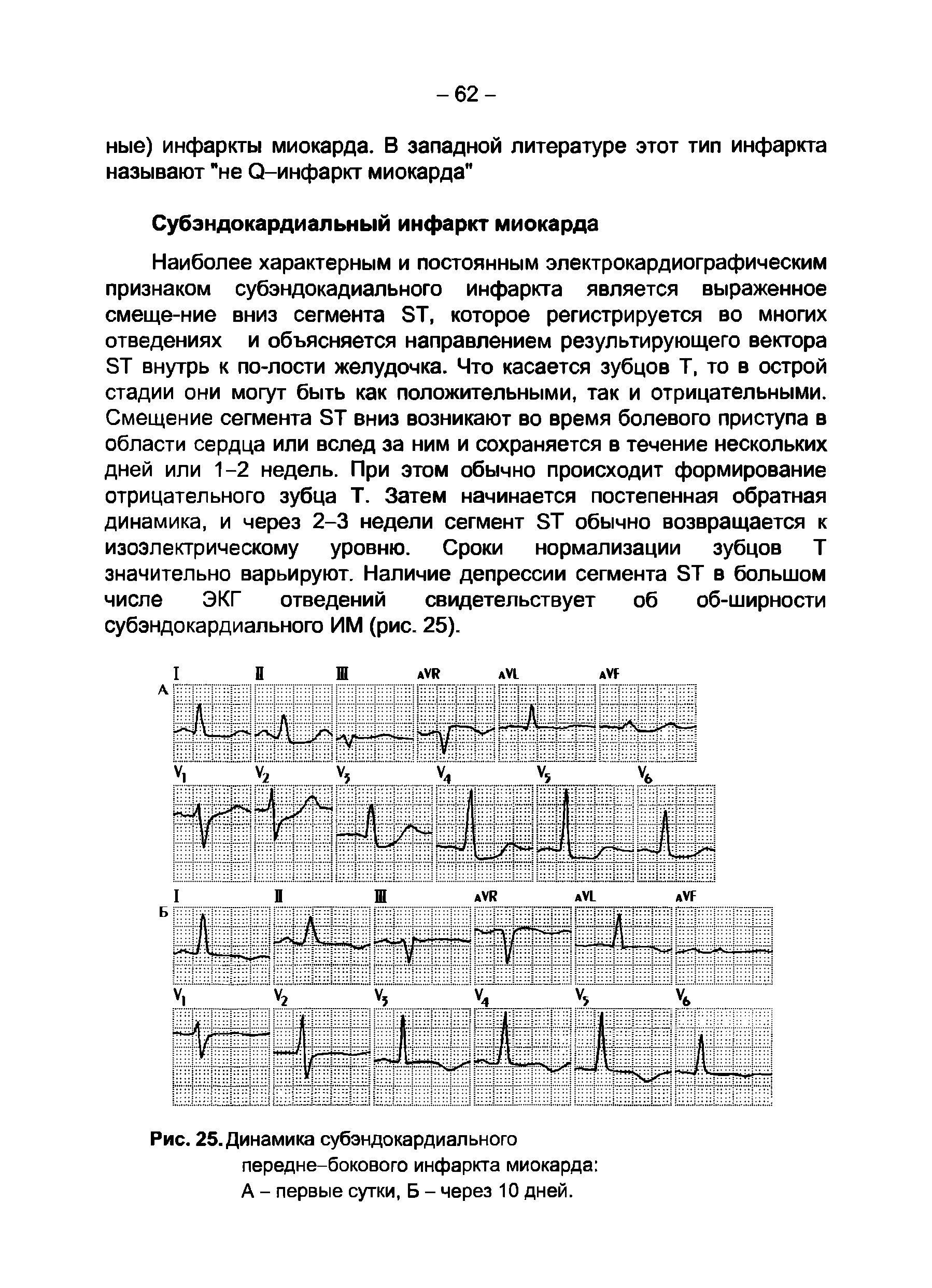 Рис. 25. Динамика субэндокардиального передне-бокового инфаркта миокарда А - первые сутки, Б - через 10 дней.