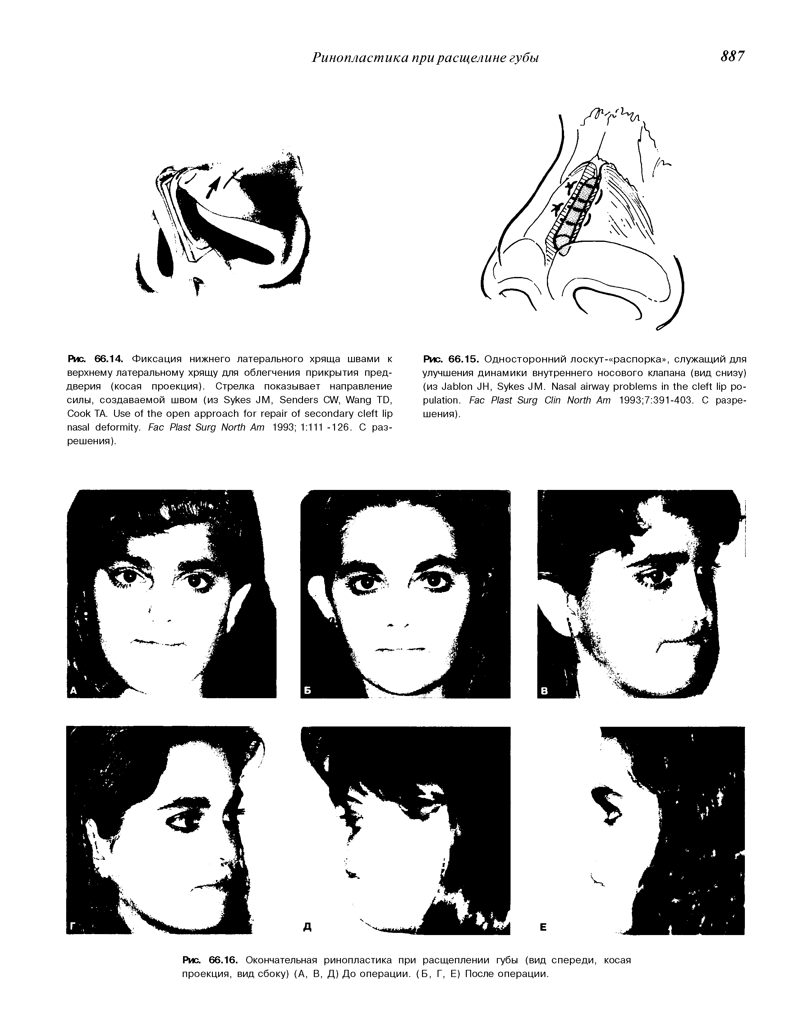 Рис. 66.16. Окончательная ринопластика при расщеплении губы (вид спереди, косая проекция, вид сбоку) (А, В, Д) До операции. (Б, Г, Е) После операции.