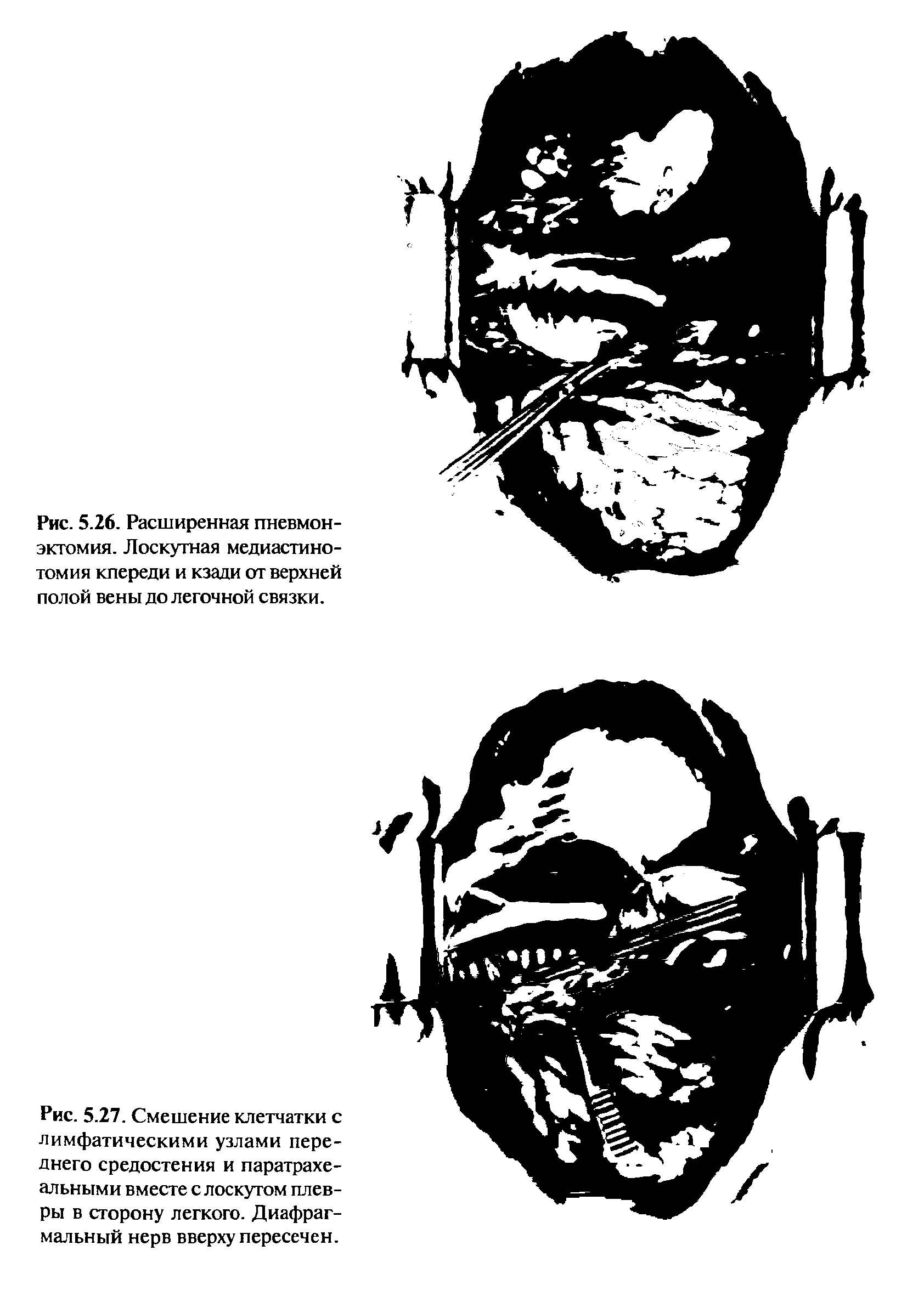Рис. 5.27. Смешение клетчатки с лимфатическими узлами переднего средостения и паратрахе-альными вместе с лоскутом плевры в сторону легкого. Диафрагмальный нерв вверху пересечен.