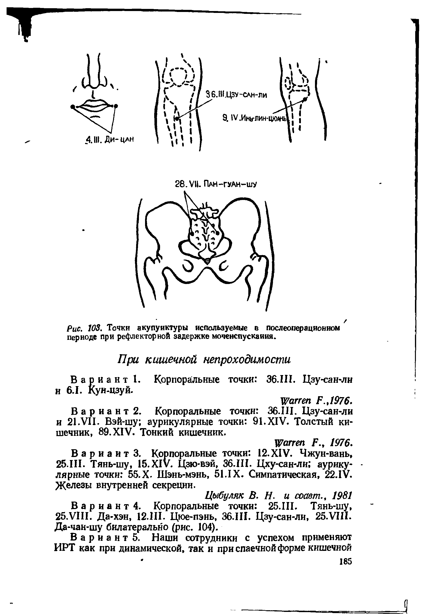 Рис. 103. Точки акупунктуры используемые в послеоперационном периоде при рефлекторной задержке мочеиспускания.