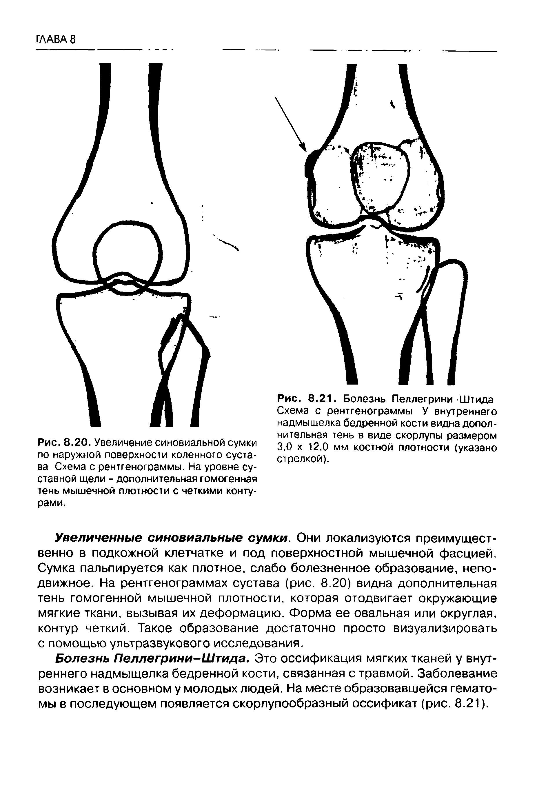 Рис. 8.21. Болезнь Пеллегрини Штида Схема с рентгенограммы У внутреннего надмыщелка бедренной кости видна дополнительная тень в виде скорлупы размером 3,0 х 12,0 мм костной плотности (указано стрелкой).