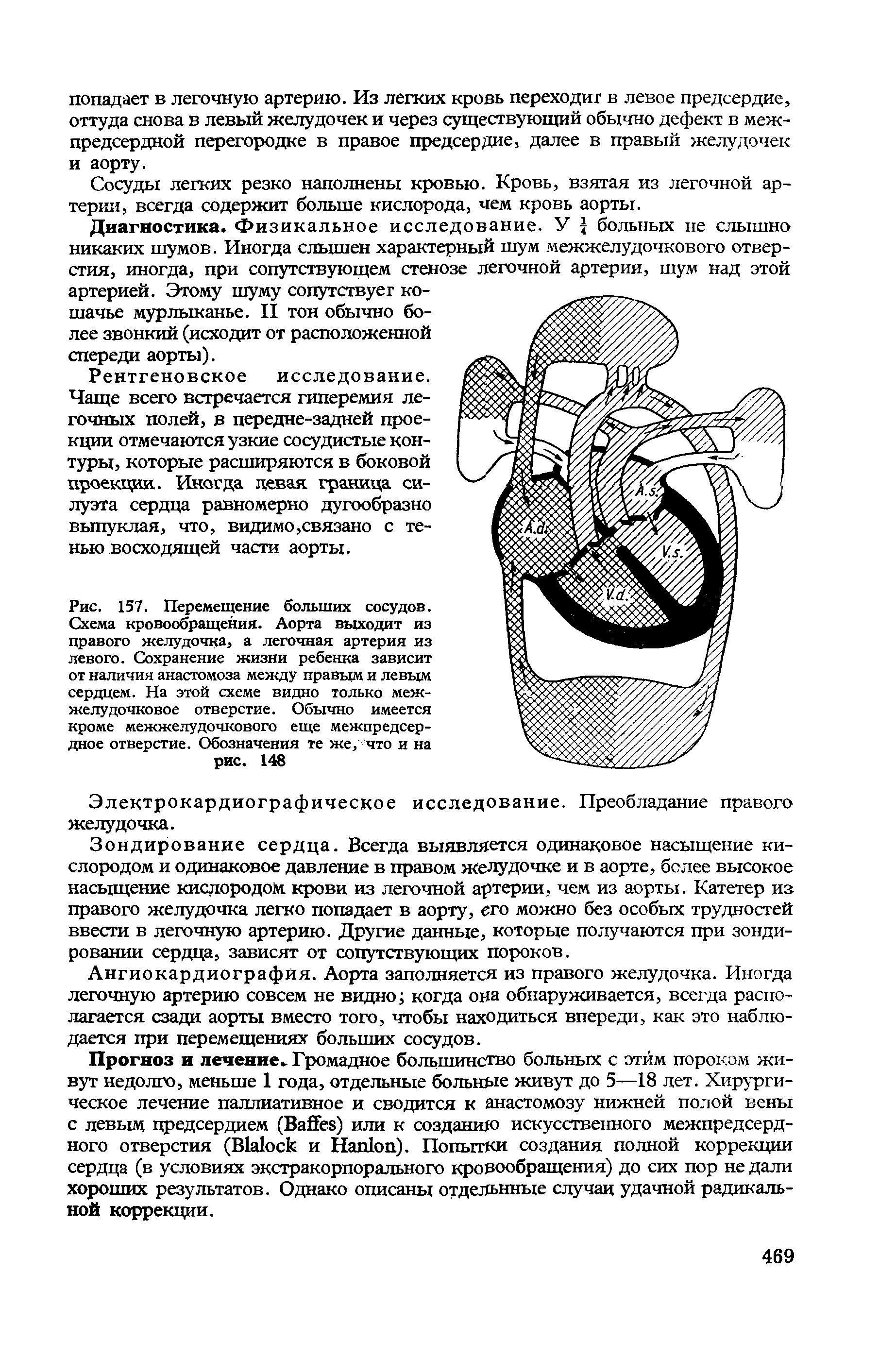 Рис. 157. Перемещение больших сосудов. Схема кровообращения. Аорта выходит из правого желудочка, а легочная артерия из левого. Сохранение жизни ребенка зависит от наличия анастомоза между правым и левым сердцем. На этой схеме видно только межжелудочковое отверстие. Обычно имеется кроме межжелудочкового еще межпредсердное отверстие. Обозначения те же, что и на рис. 148...