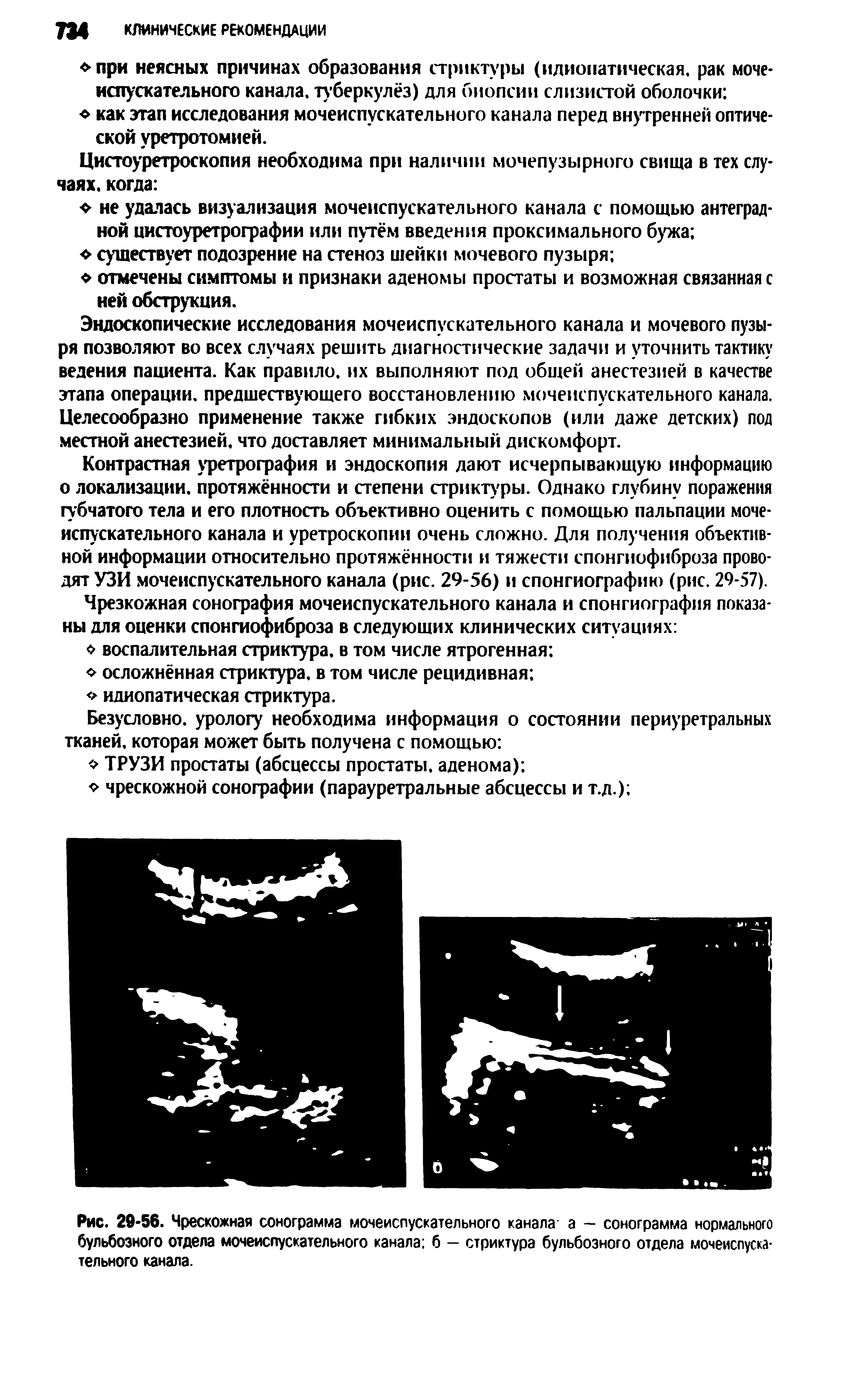 Рис. 29-56. Чрескожная сонограмма мочеиспускательного канала а — сонограмма нормального бульбозного отдела мочеиспускательного канала б — стриктура бульбозного отдела мочеиспускательного канала.