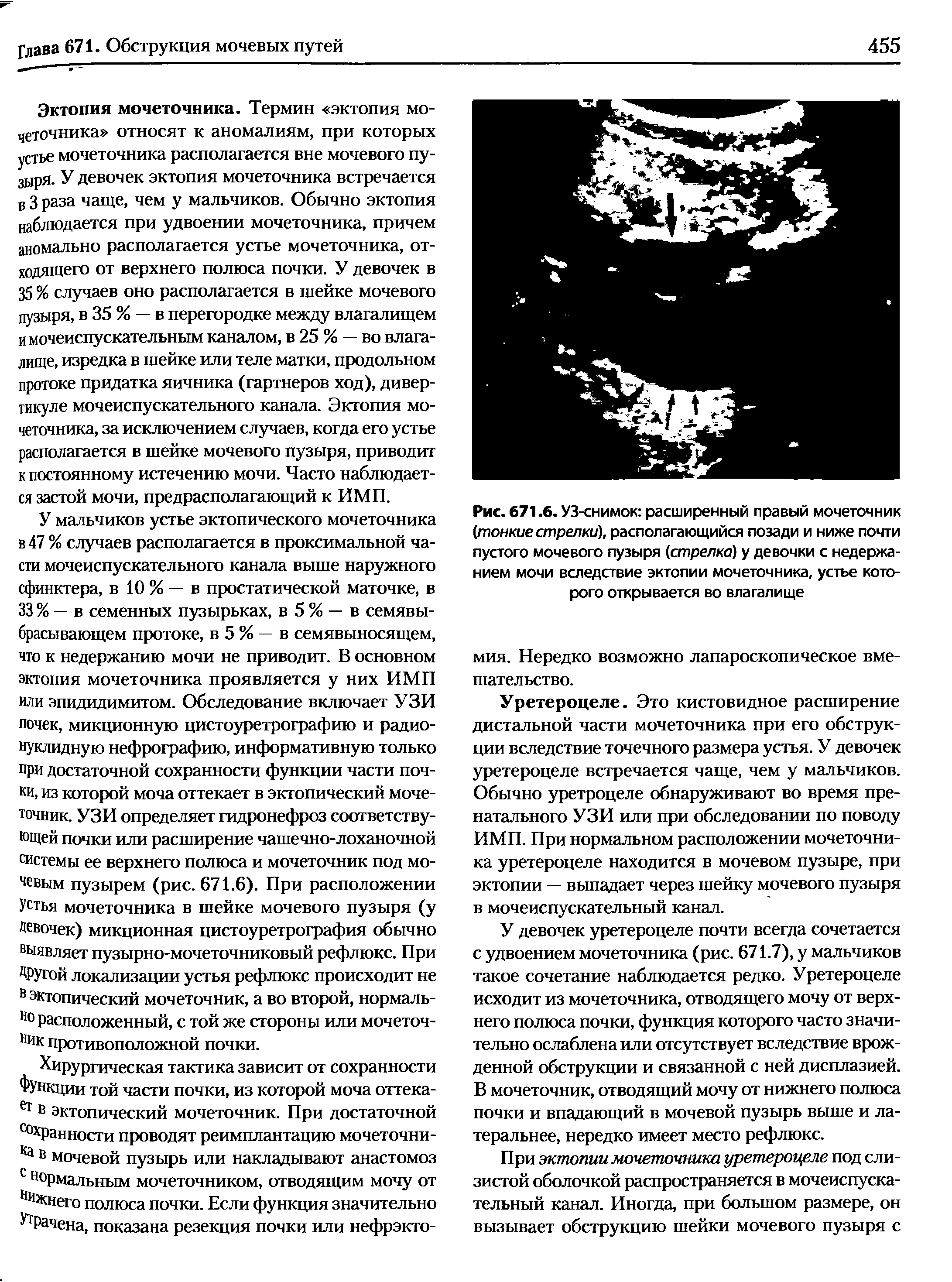 Рис. 671.6. УЗ-снимок расширенный правый мочеточник (тонкие стрелки), располагающийся позади и ниже почти пустого мочевого пузыря (стрелка) у девочки с недержанием мочи вследствие эктопии мочеточника, устье которого открывается во влагалище...