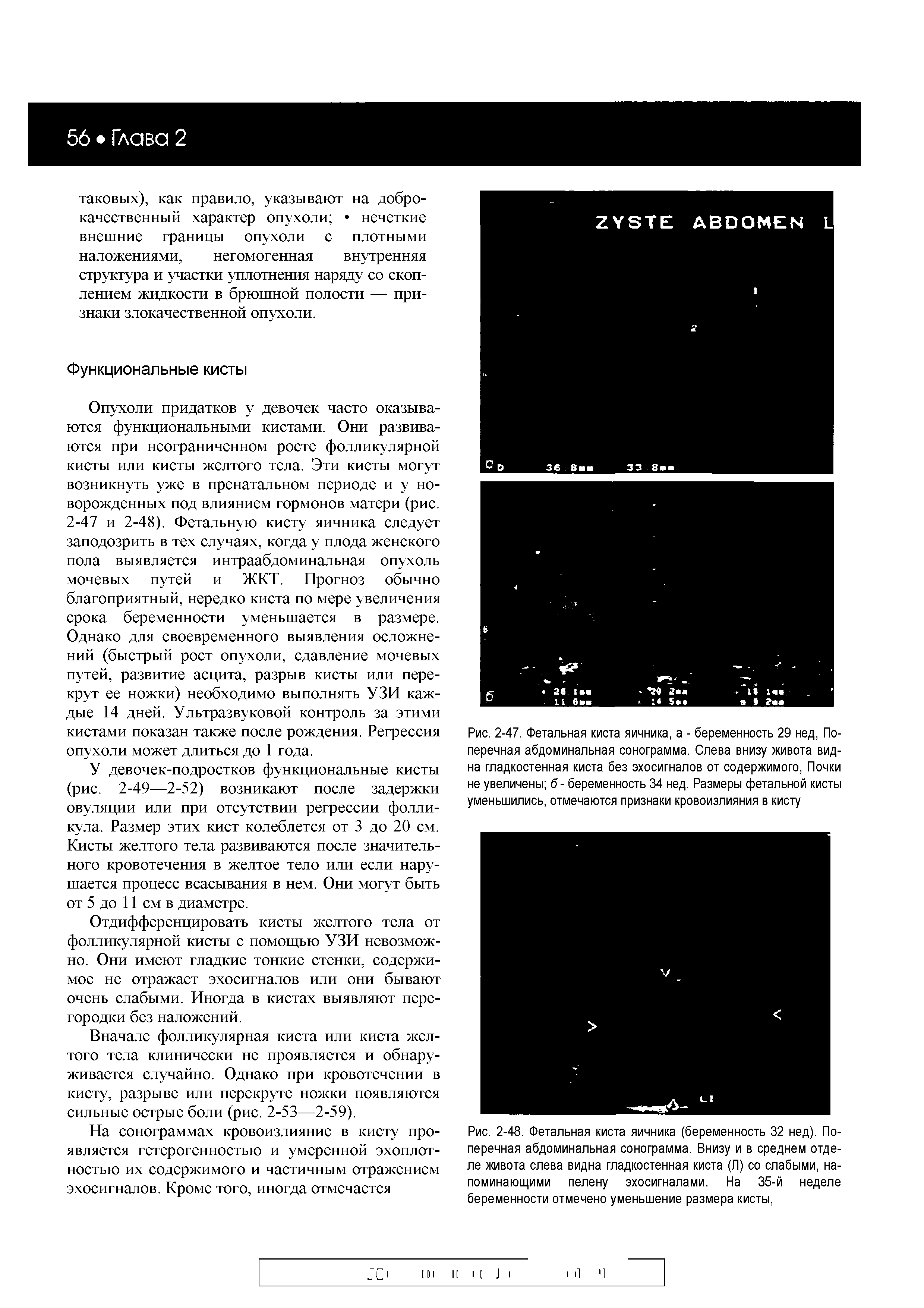 Рис. 2-48. Фетальная киста яичника (беременность 32 нед). Поперечная абдоминальная сонограмма. Внизу и в среднем отделе живота слева видна гладкостенная киста (Л) со слабыми, напоминающими пелену эхосигналами. На 35-й неделе беременности отмечено уменьшение размера кисты,...