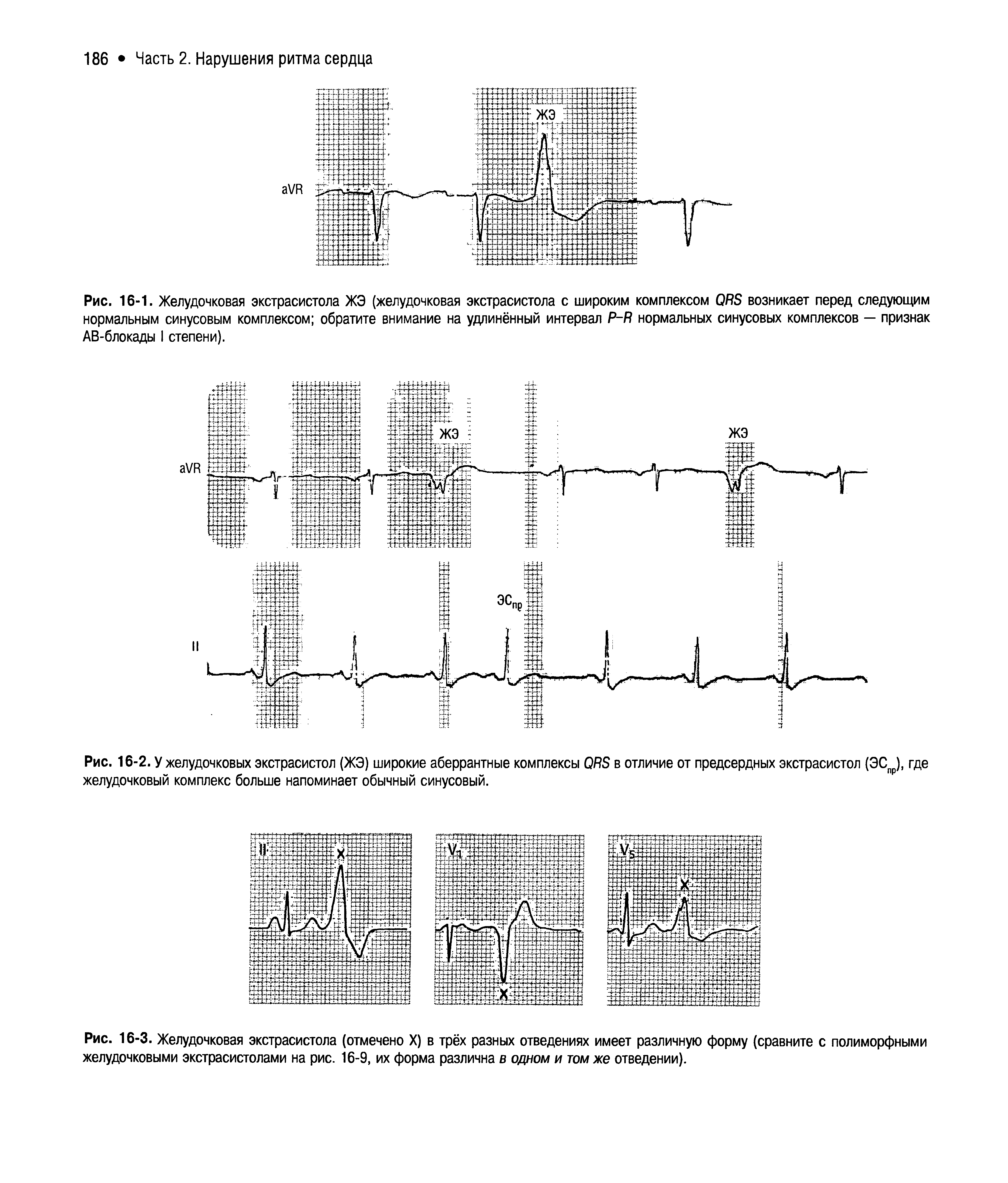 Рис. 16-3. Желудочковая экстрасистола (отмечено X) в трёх разных отведениях имеет различную форму (сравните с полиморфными желудочковыми экстрасистолами на рис. 16-9, их форма различна в одном и том же отведении).