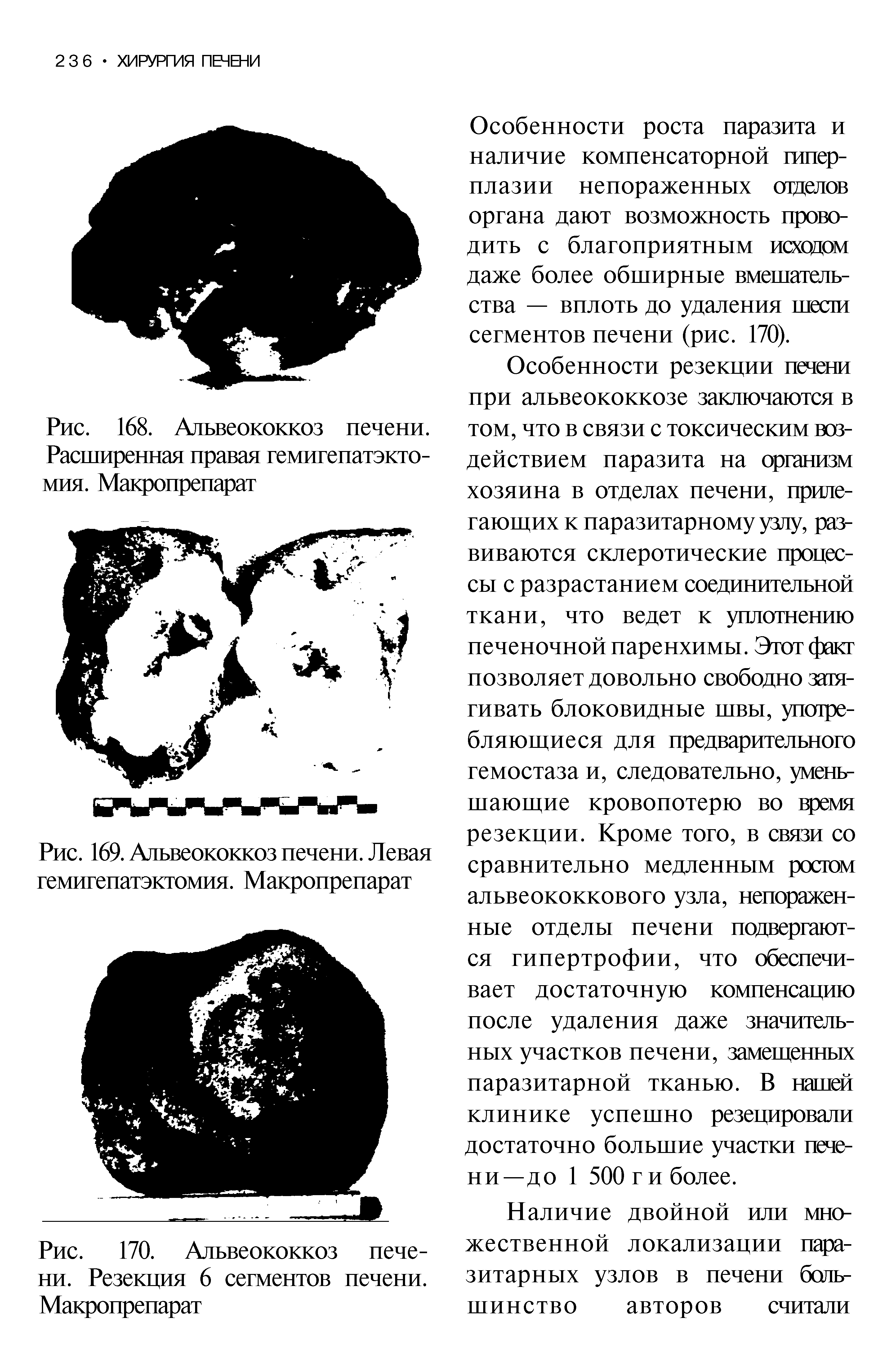 Рис. 170. Альвеококкоз печени. Резекция 6 сегментов печени. Макропрепарат...