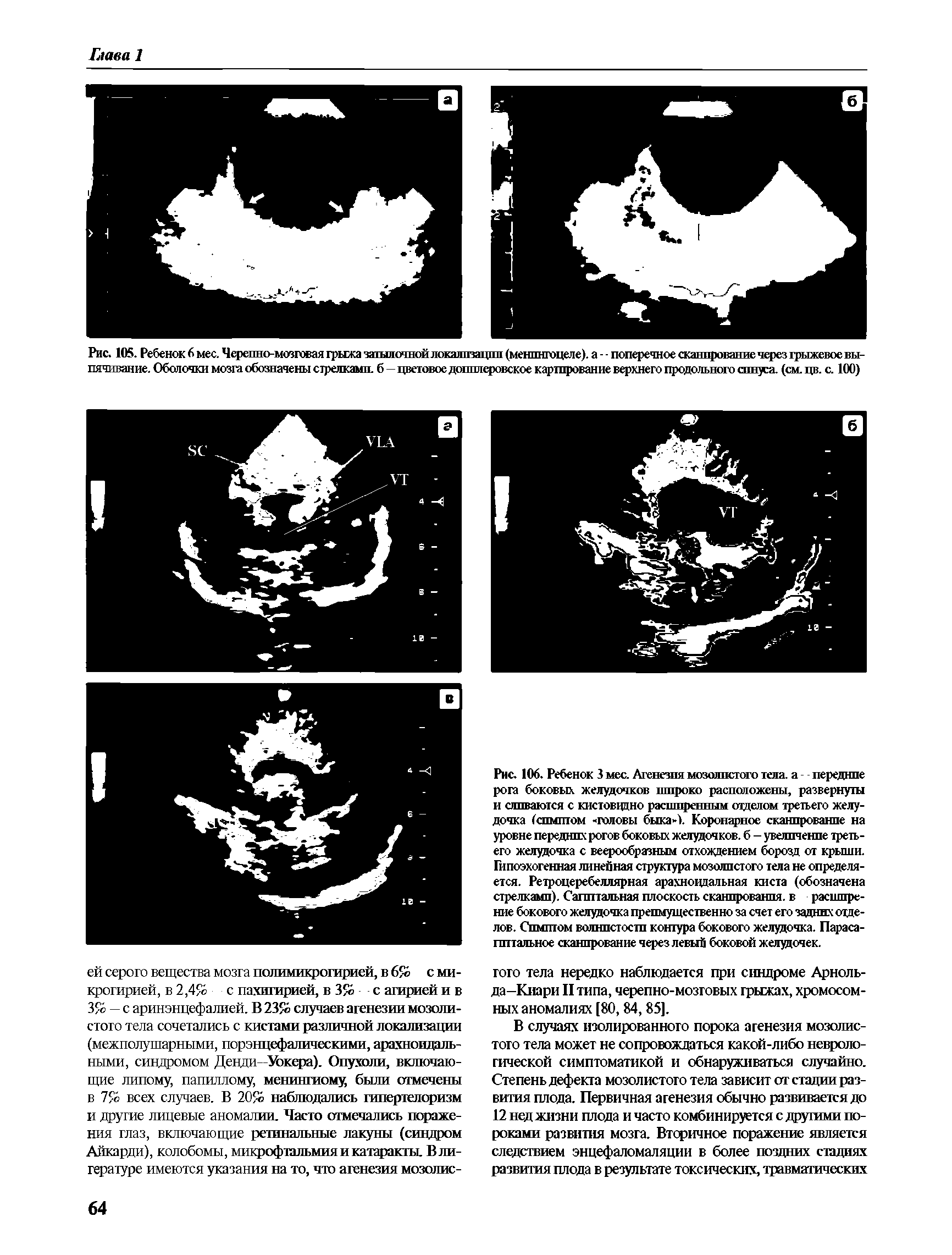 Рис. 105. Ребенок 6 мес. Черепно-мозговая грыжа затылочной локализации (менингоцеле), а - - поперечное сканирование через грыжевое. ш-пячивание. Оболочки мозга обозначены стрелками, б—цветовое допплеровское картирование верхнего продольного спнуя. (см. цв. с. 100)...
