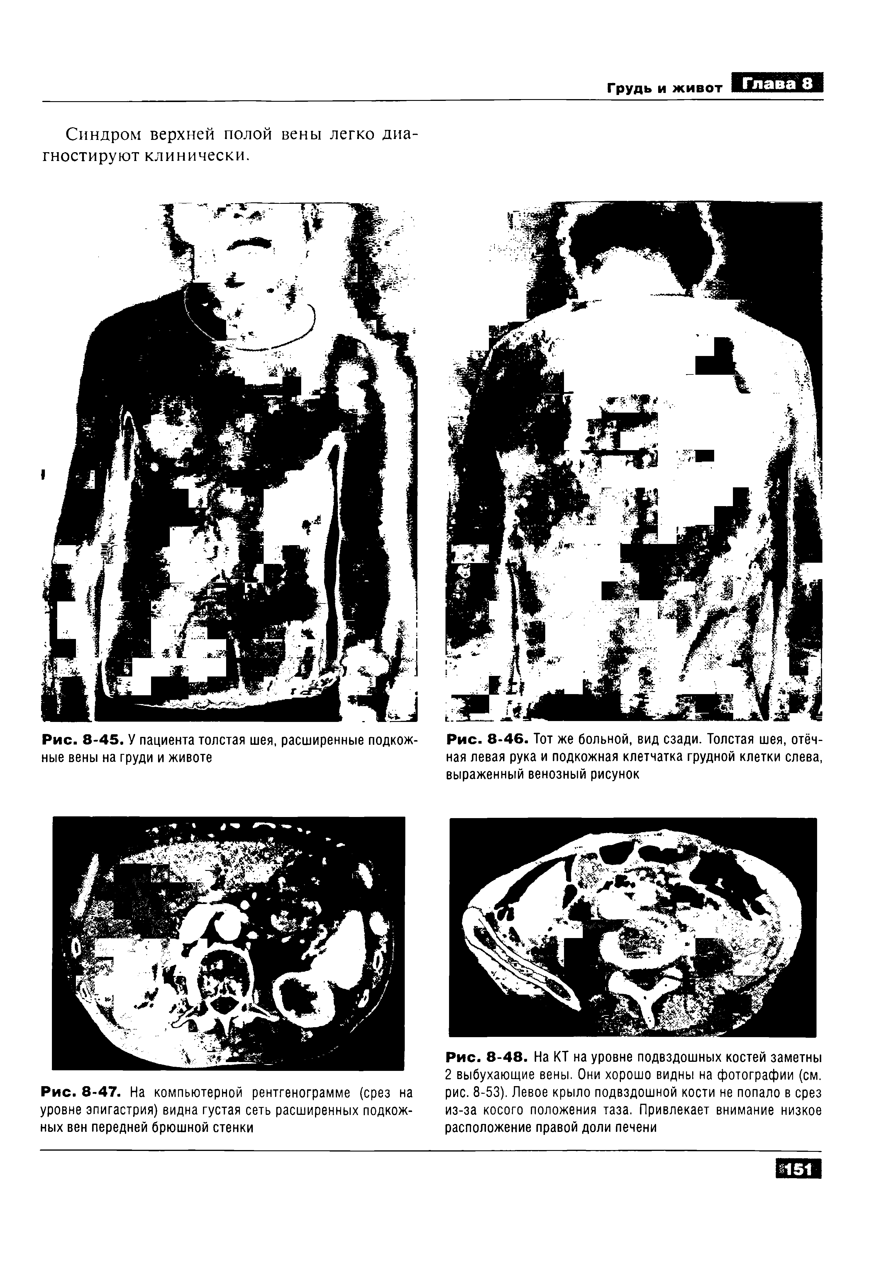 Рис. 8-48. На КТ на уровне подвздошных костей заметны 2 выбухающие вены. Они хорошо видны на фотографии (см. рис. 8-53). Левое крыло подвздошной кости не попало в срез из-за косого положения таза. Привлекает внимание низкое расположение правой доли печени...