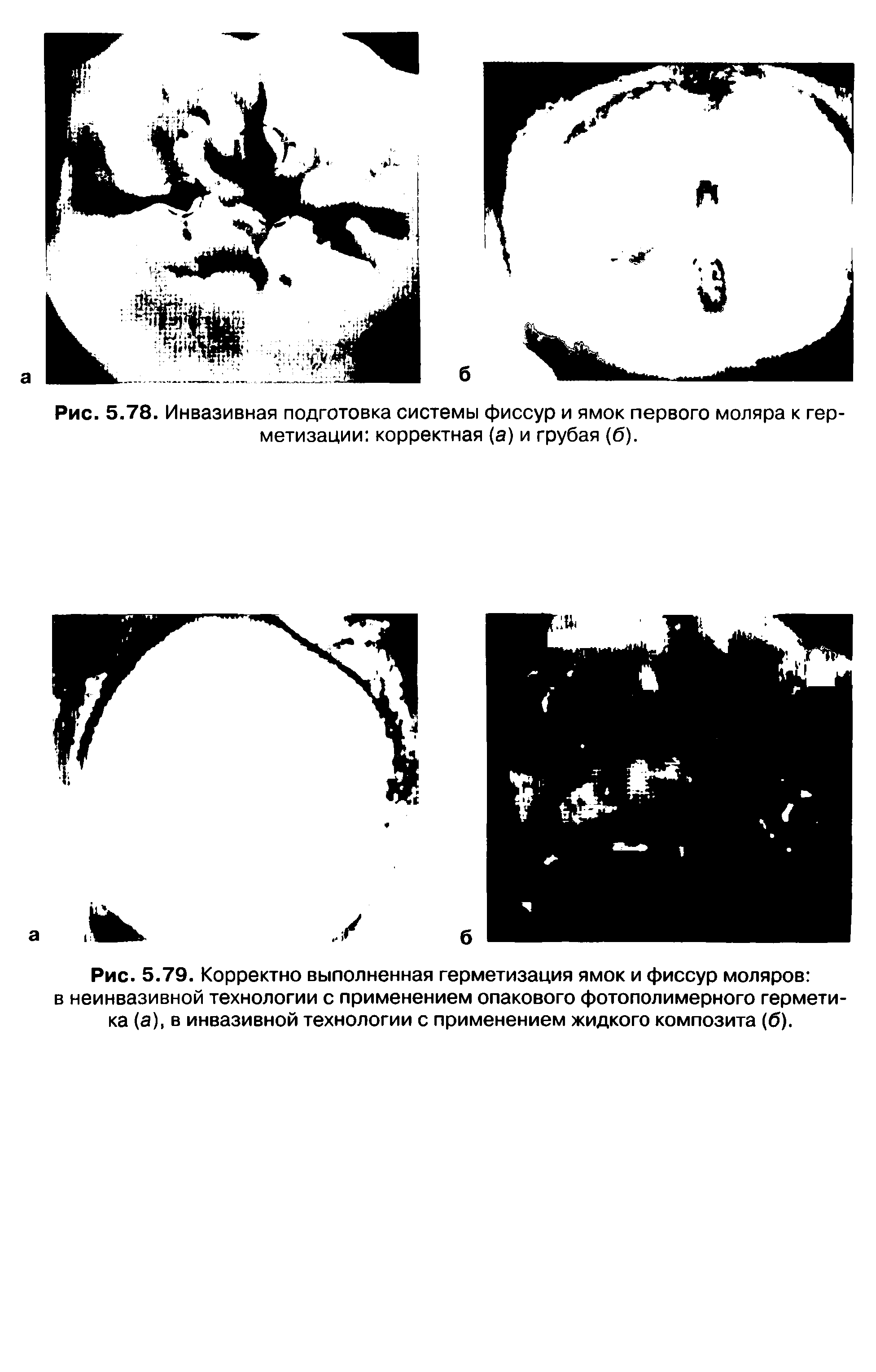 Рис. 5.79. Корректно выполненная герметизация ямок и фиссур моляров в неинвазивной технологии с применением опакового фотополимерного герметика (а), в инвазивной технологии с применением жидкого композита (б).