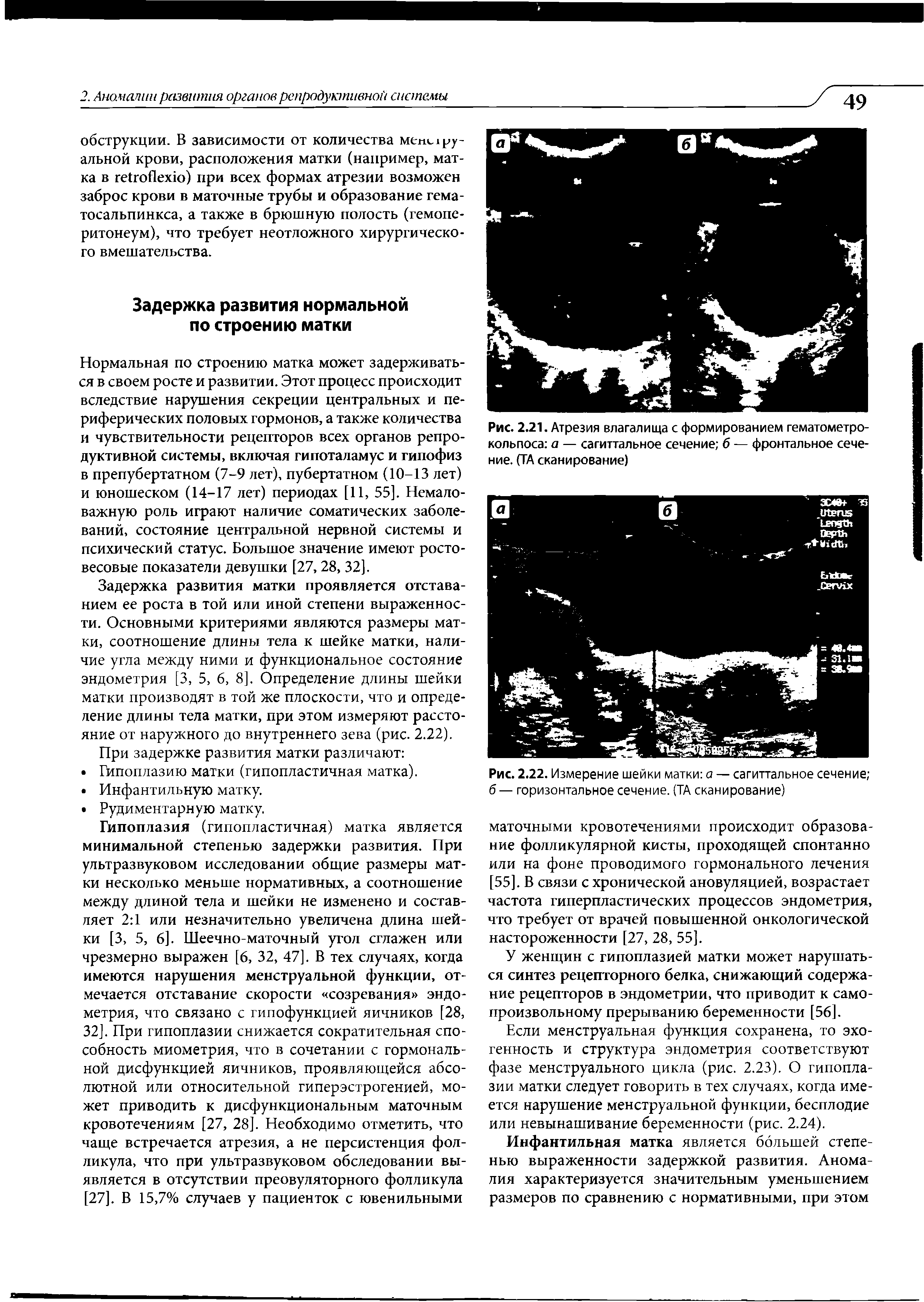 Рис. 2.21. Атрезия влагалища с формированием гематометро-кольпоса а — сагиттальное сечение б — фронтальное сечение. (ТА сканирование)...