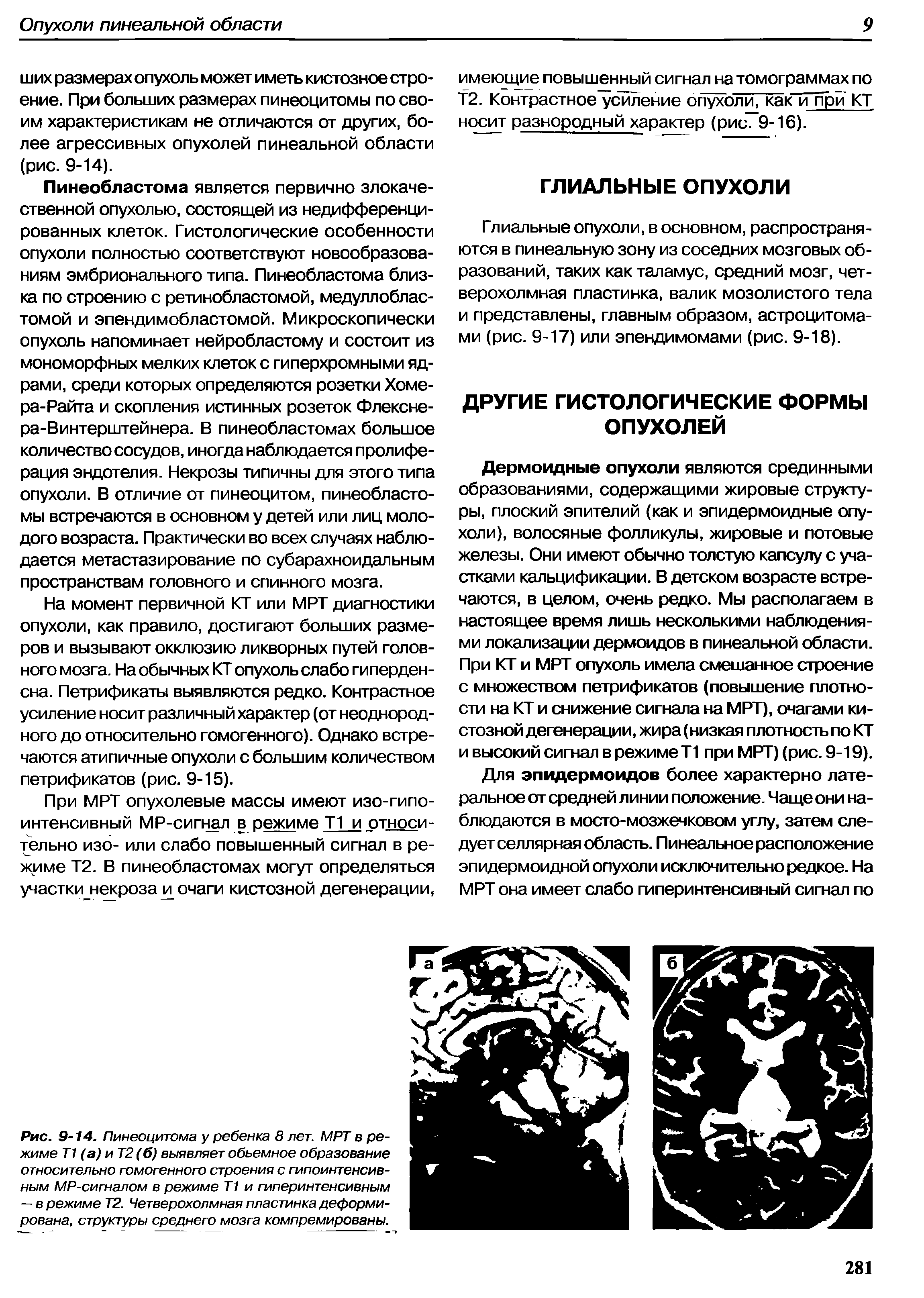 Рис. 9-14. Пинеоцитома у ребенка 8 лет. МРТ в режиме Т1 (а) и Т2(б) выявляет обьемное образование относительно гомогенного строения с гипоинтенсив-ным MP-сигналом в режиме Т1 и гиперинтенсивным — в режиме Т2. Четверохолмная пластинка деформирована, структуры среднего мозга компремированы.