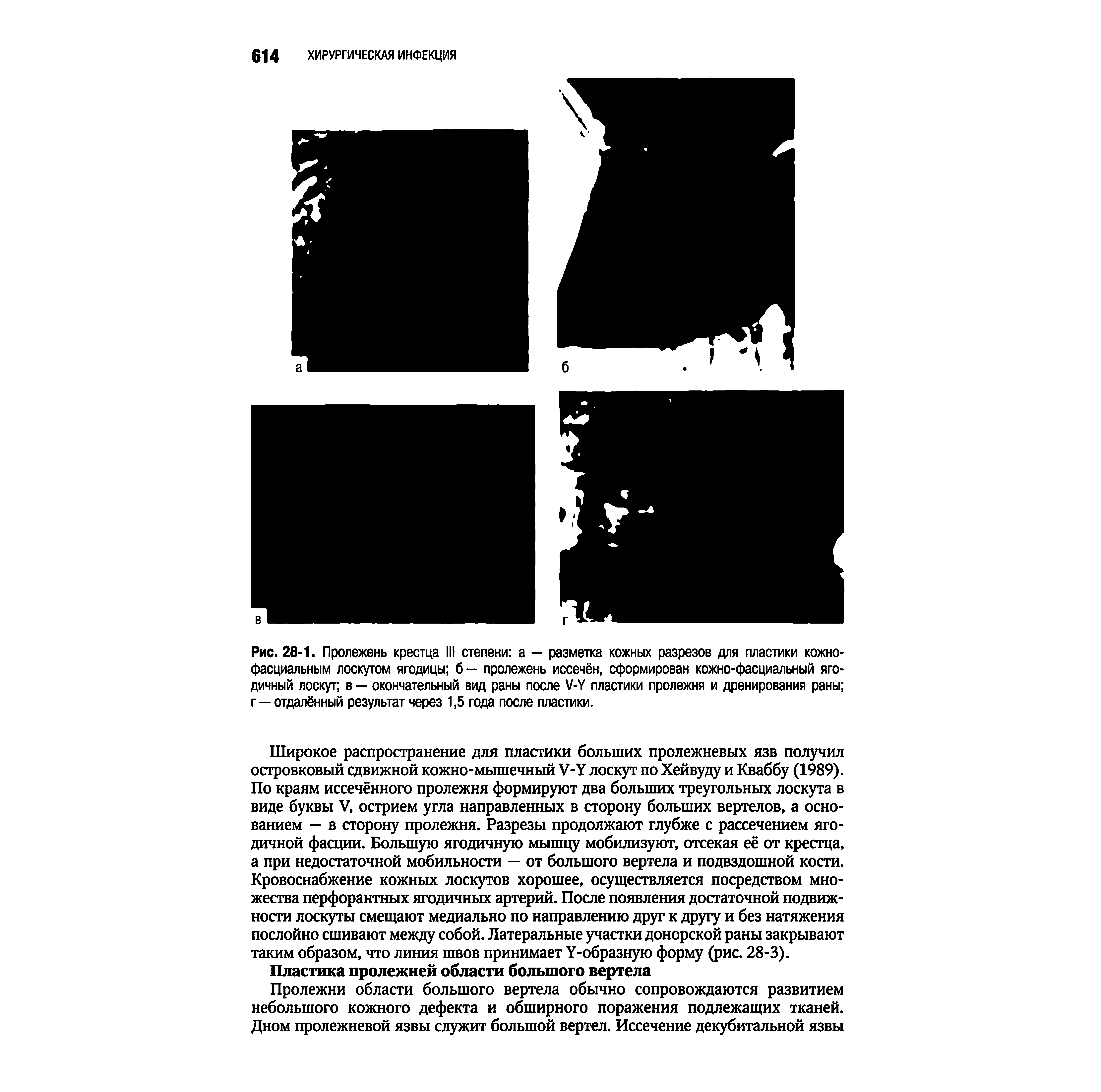 Рис. 28-1. Пролежень крестца III степени а — разметка кожных разрезов для пластики кожнофасциальным лоскутом ягодицы б — пролежень иссечён, сформирован кожно-фасциальный ягодичный лоскут в — окончательный вид раны после V-Y пластики пролежня и дренирования раны г — отдалённый результат через 1,5 года после пластики.