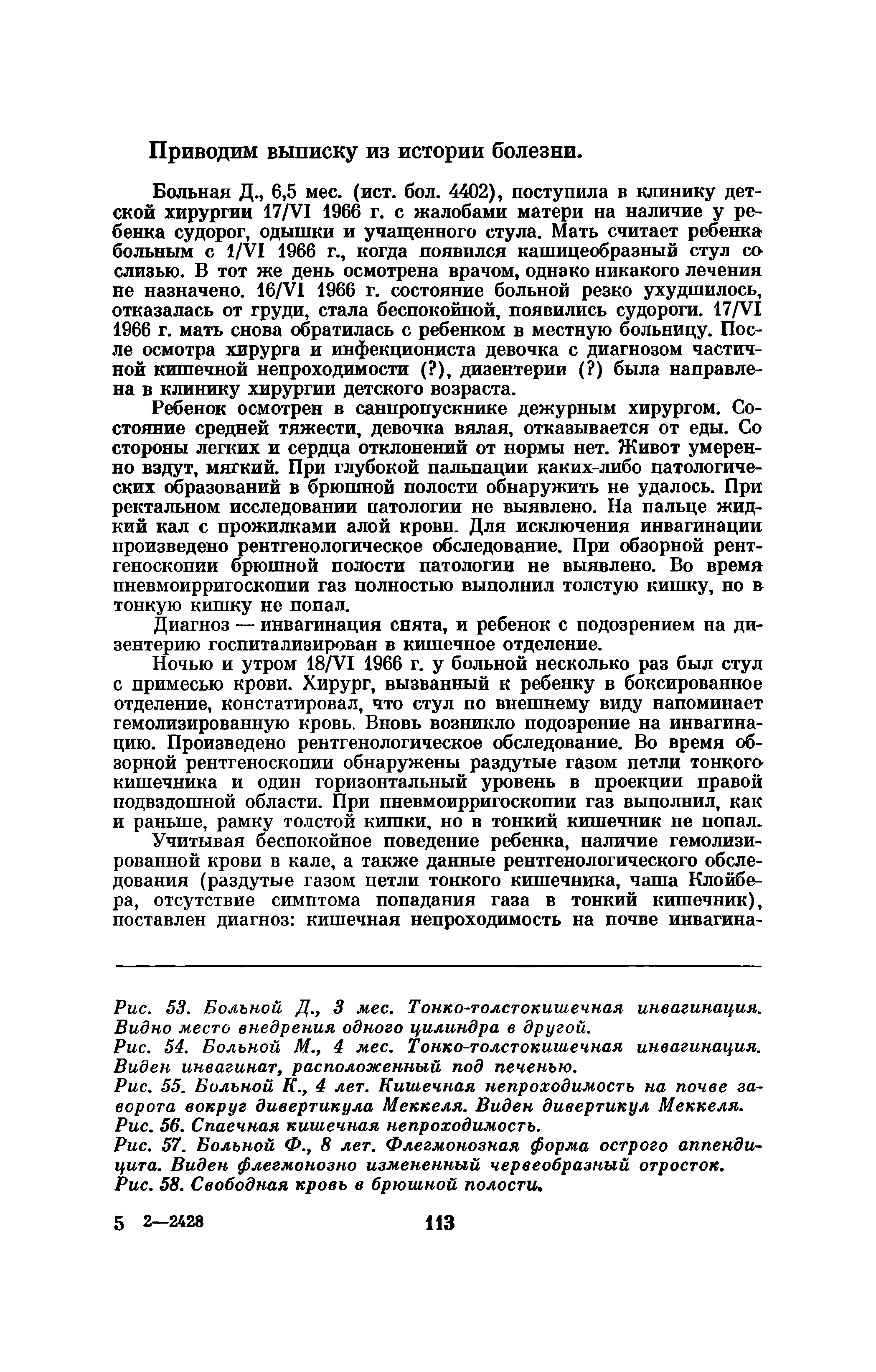 Рис. 55. Больной К., 4 лет. Кишечная непроходимость на почве заворота вокруг дивертикула Меккеля. Виден дивертикул Меккеля. Рис. 56. Спаечная кишечная непроходимость.