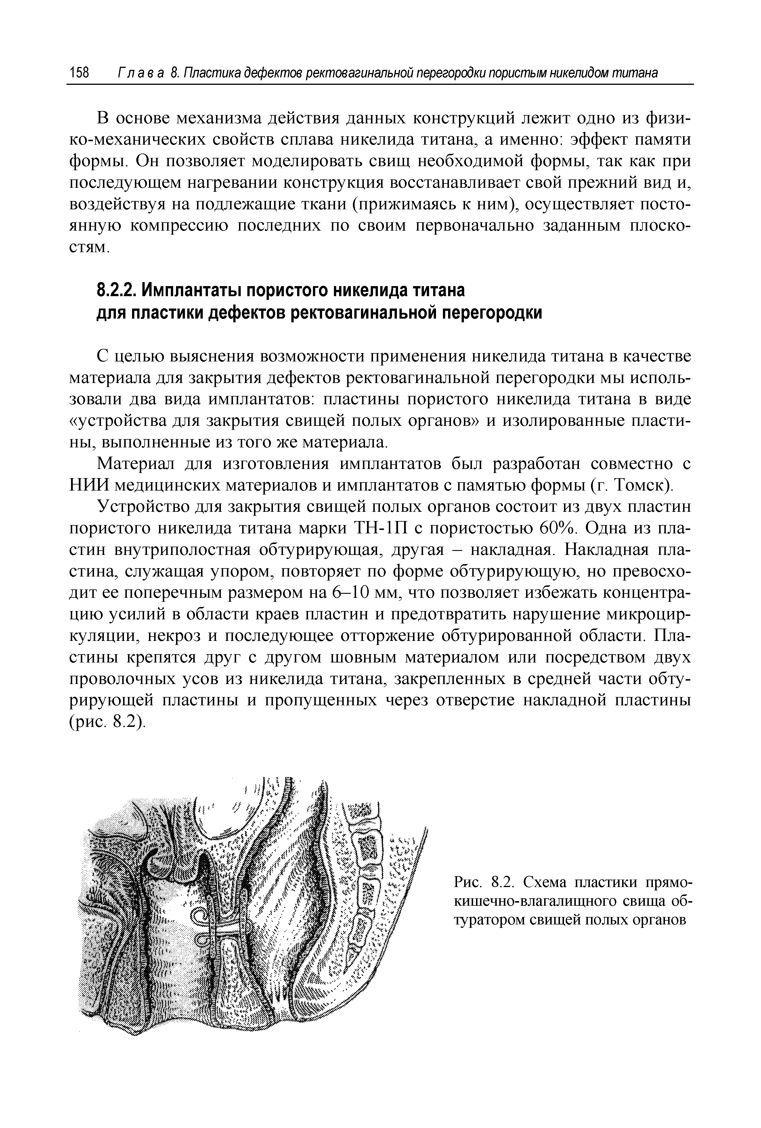 Рис. 8.2. Схема пластики прямокишечно-влагалищного свища обтуратором свищей полых органов...