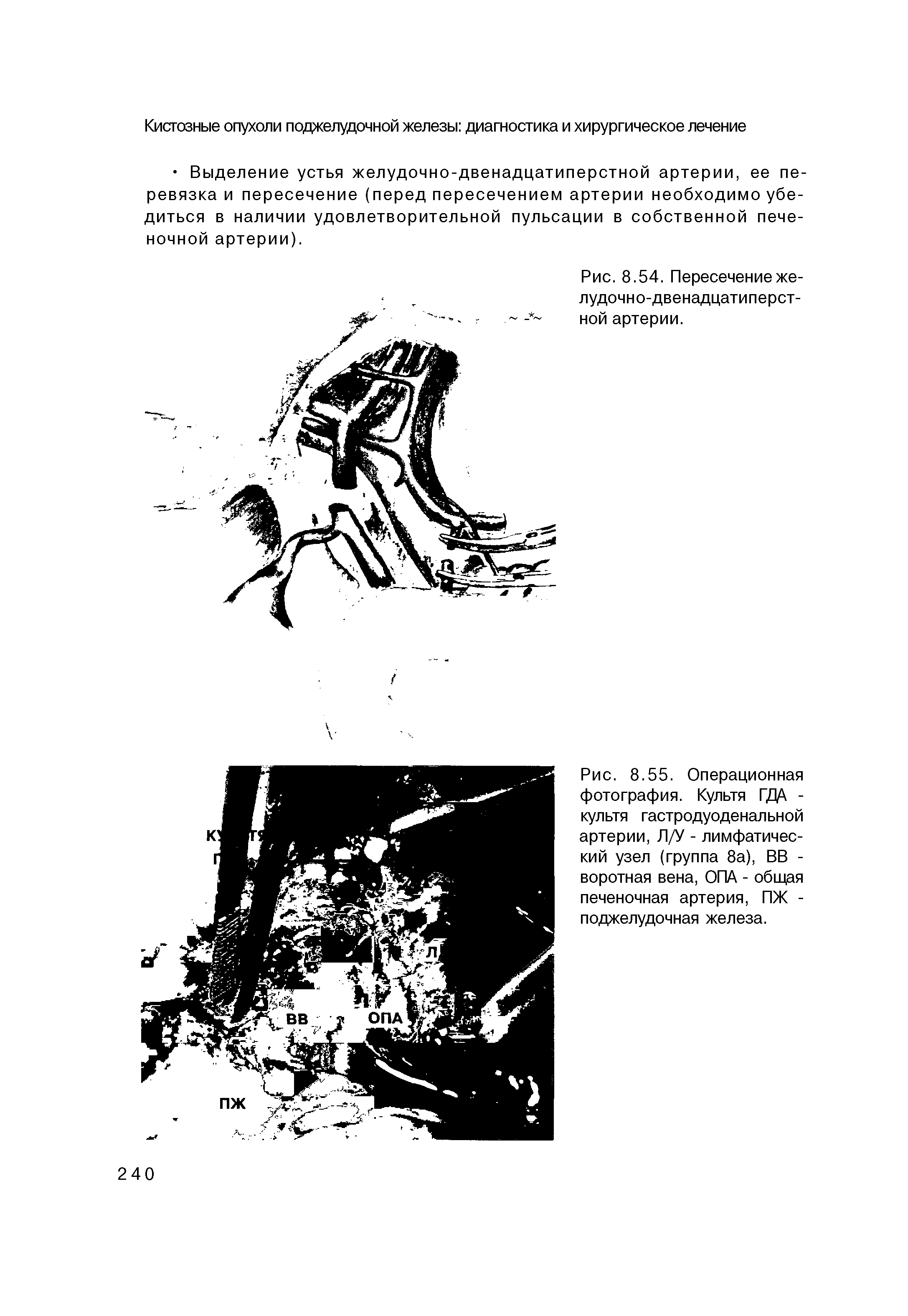 Рис. 8.55. Операционная фотография. Культя ГД4 -культя гастродуоденальной артерии, Л/У - лимфатический узел (группа 8а), ВВ -воротная вена, ОПА - общая печеночная артерия, ПЖ -поджелудочная железа.