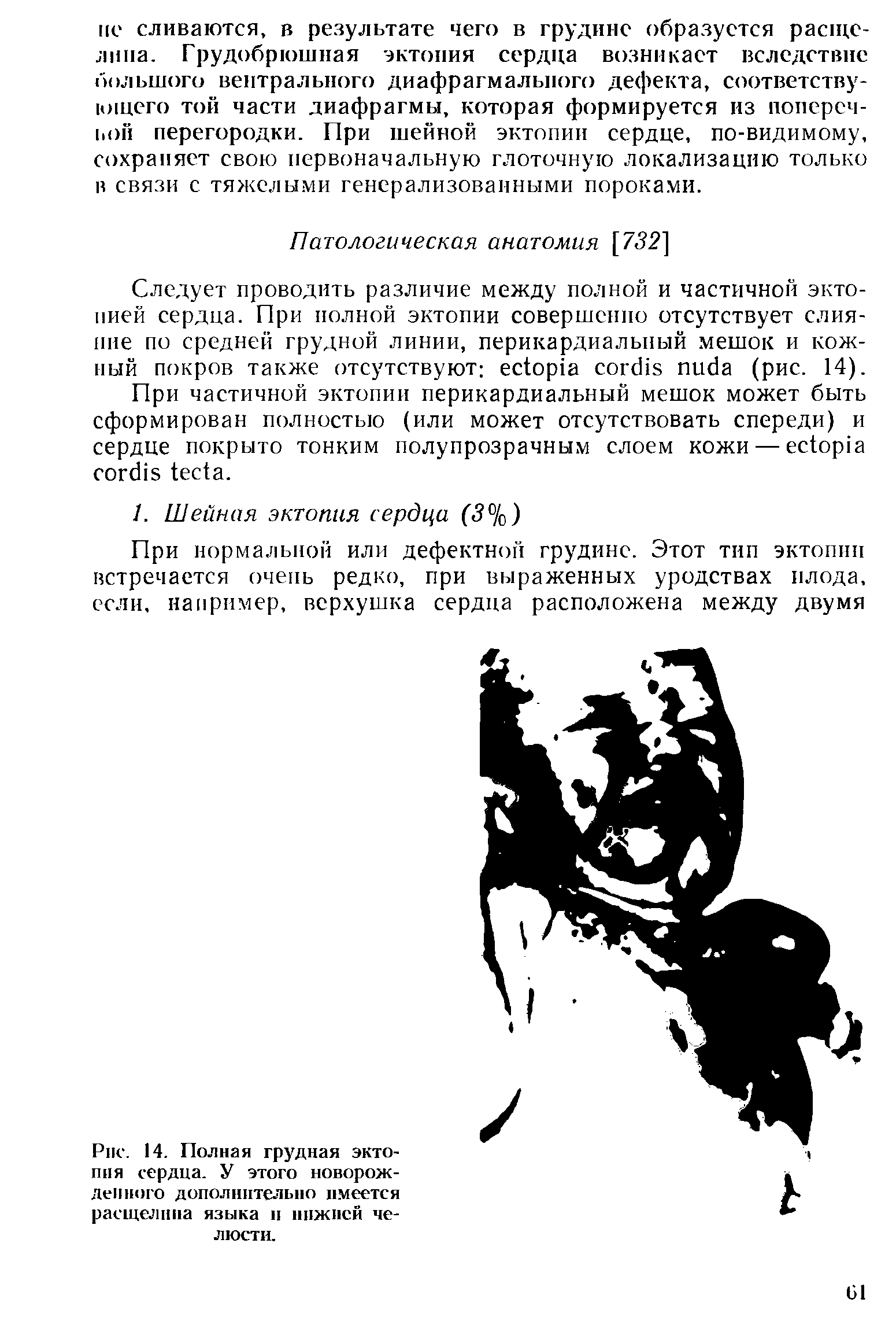 Рис. 14. Полная грудная экто-пня сердца. У этого новорожденного дополнительно имеется расщелина языка н ппжисй челюсти.