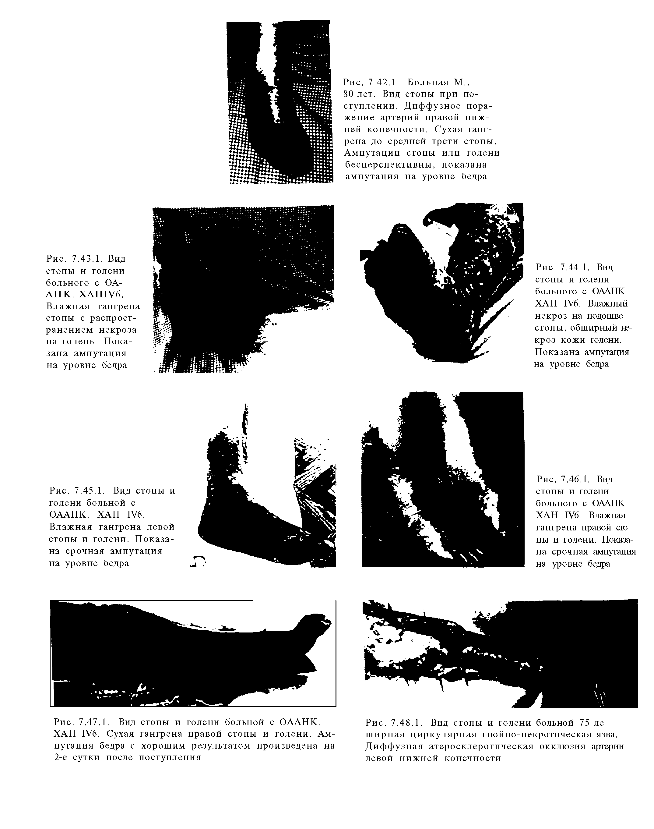 Рис. 7.47.1. Вид стопы и голени больной с ОААНК. ХАН 1У6. Сухая гангрена правой стопы и голени. Ампутация бедра с хорошим результатом произведена на 2-е сутки после поступления...