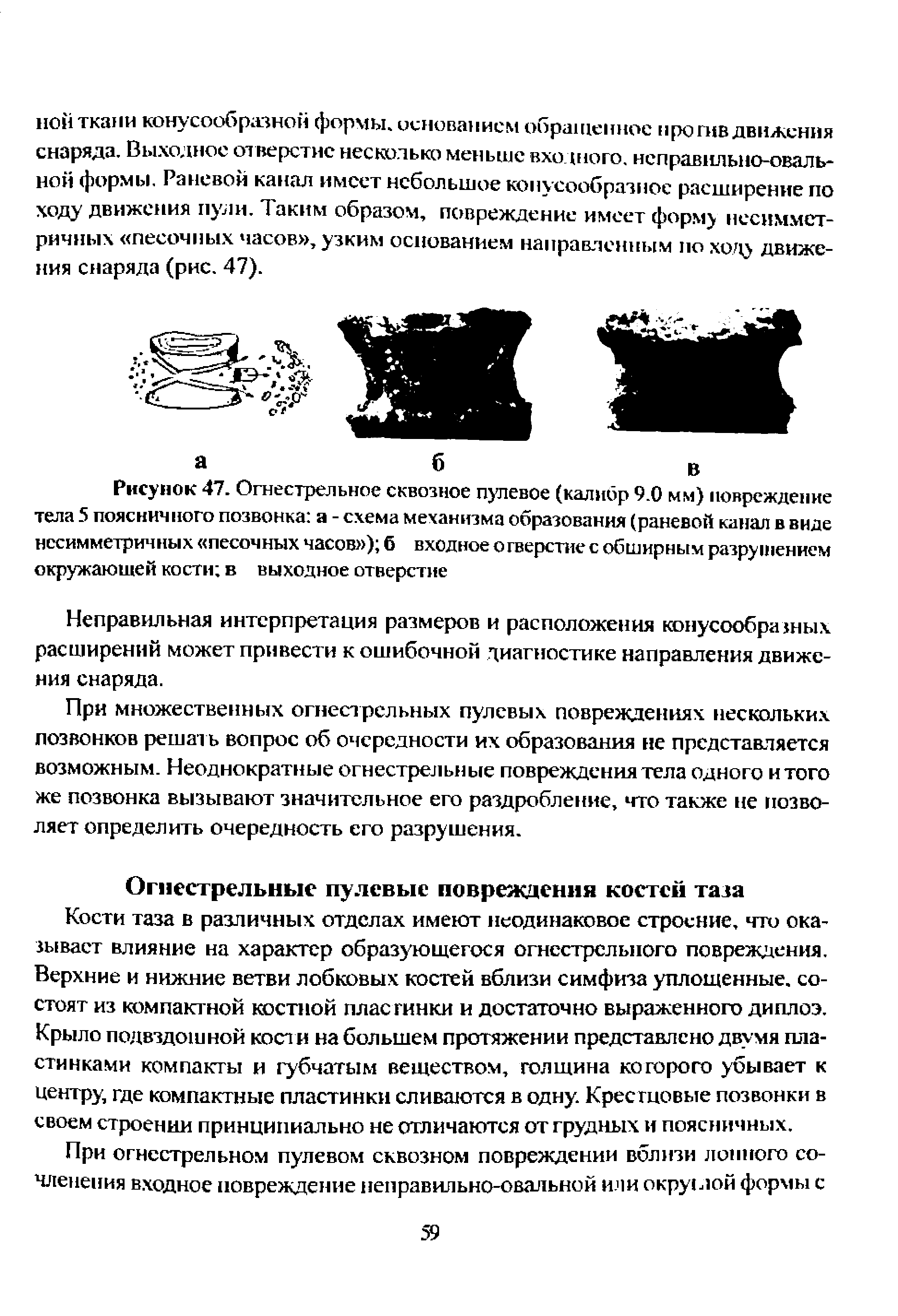 Рисунок 47. Огнестрельное сквозное пулевое (калибр 9.0 мм) повреждение тела 5 поясничного позвонка а - схема механизма образования (раневой канал в виде несимметричных песочных часов ) б входное о гверстие с обширным разрушением окружающей кости в выходное отверстие...