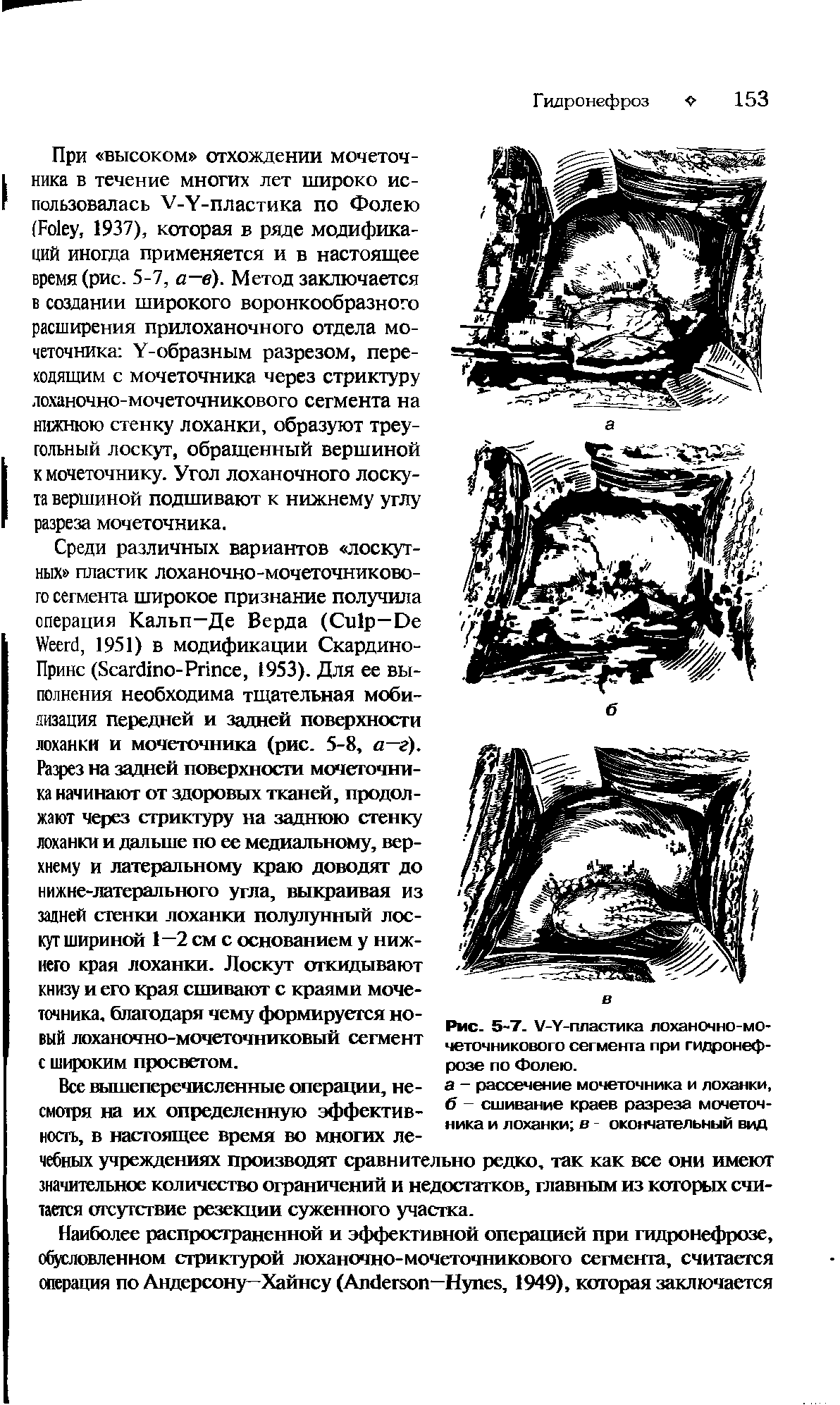 Рис. 5-7. У-У-пластика лоханочно-мочеточникового сегмента при гидронефрозе по Фолею.