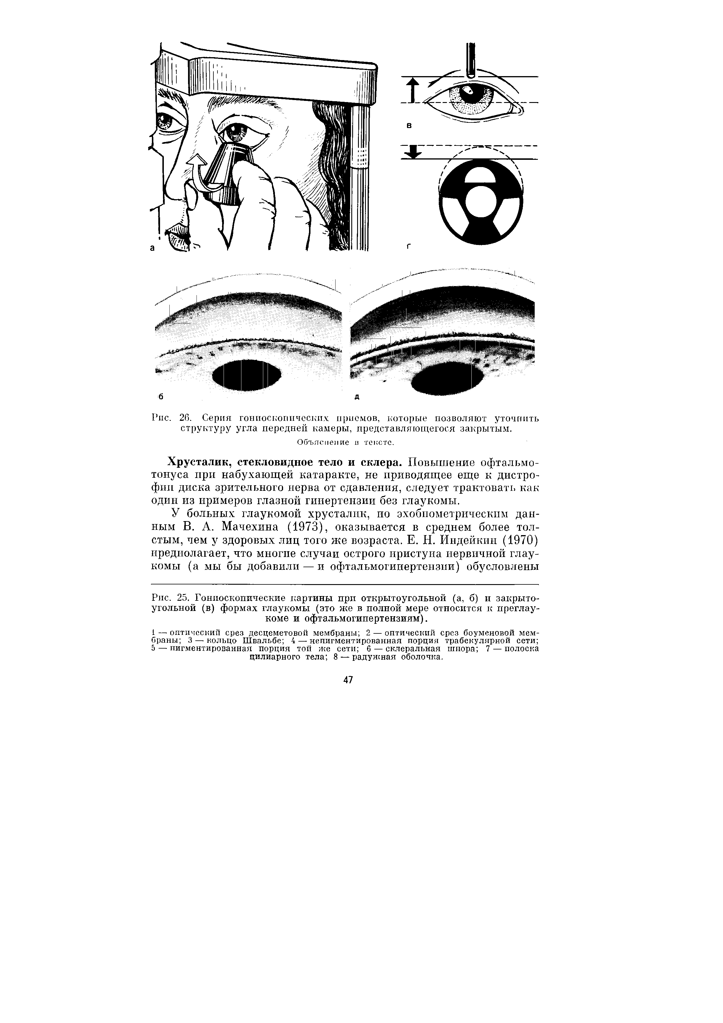 Рис. 25. Гониоскопические картины при открытоугольной (а, б) и закрытоугольной (в) формах глаукомы (это же в полной мере относится к преглаукоме и офтальмогипертензиям).