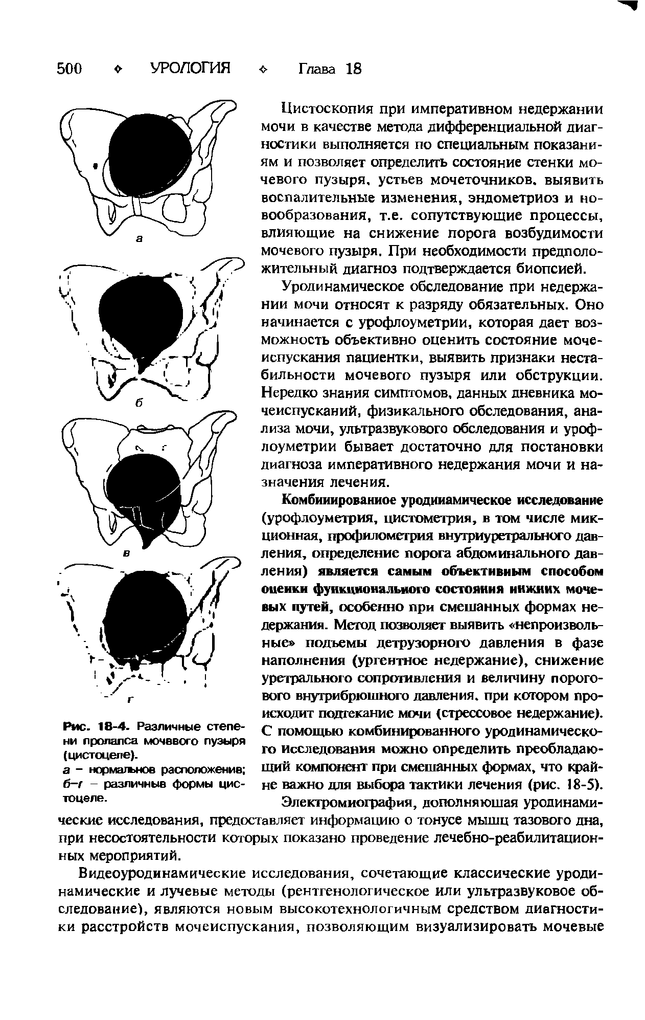 Рис. 18-4. Различные степени пролапса мочевого пузыря (цистоцеле).