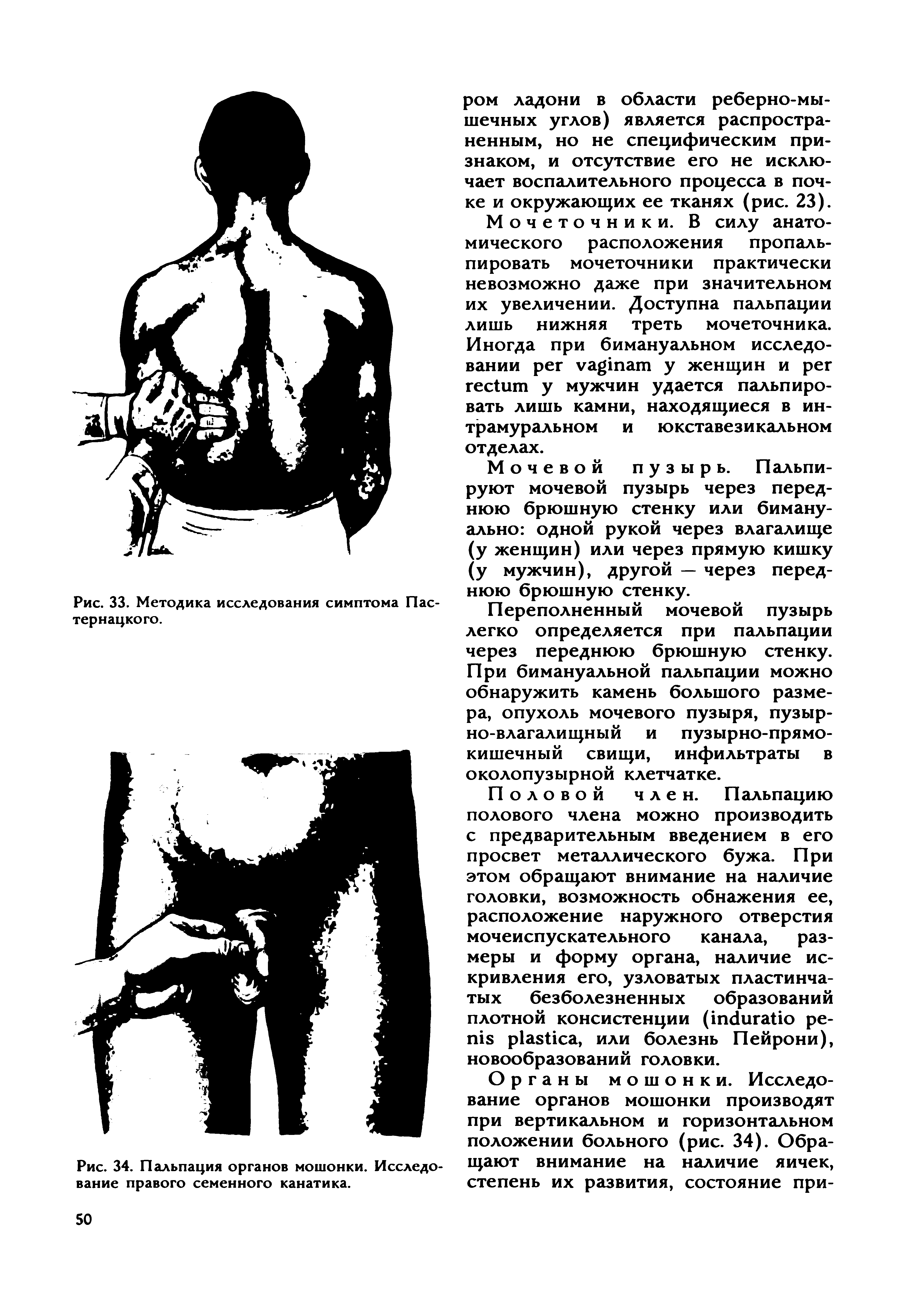 Рис. 34. Пальпация органов мошонки. Исследование правого семенного канатика.