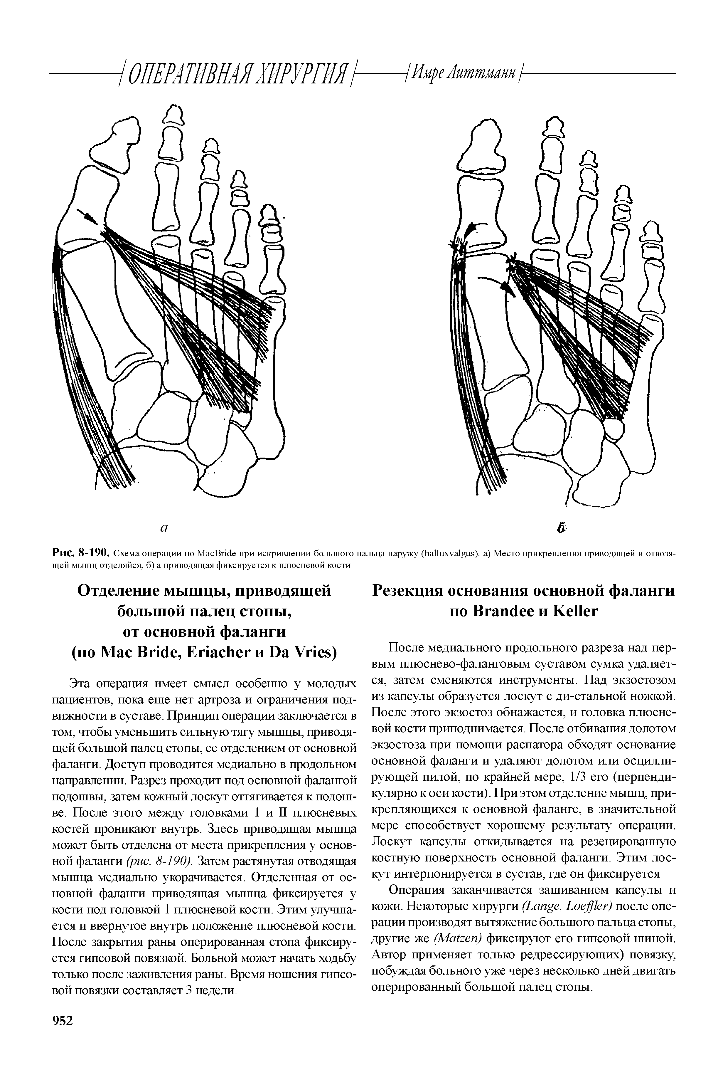 Рис. 8-190. Схема операции по МасВйс1е при искривлении большого пальца наружу (ЬаПихуа в). а) Место прикрепления приводящей и отвозящей мышц отделяйся, б) а приводящая фиксируется к плюсневой кости...