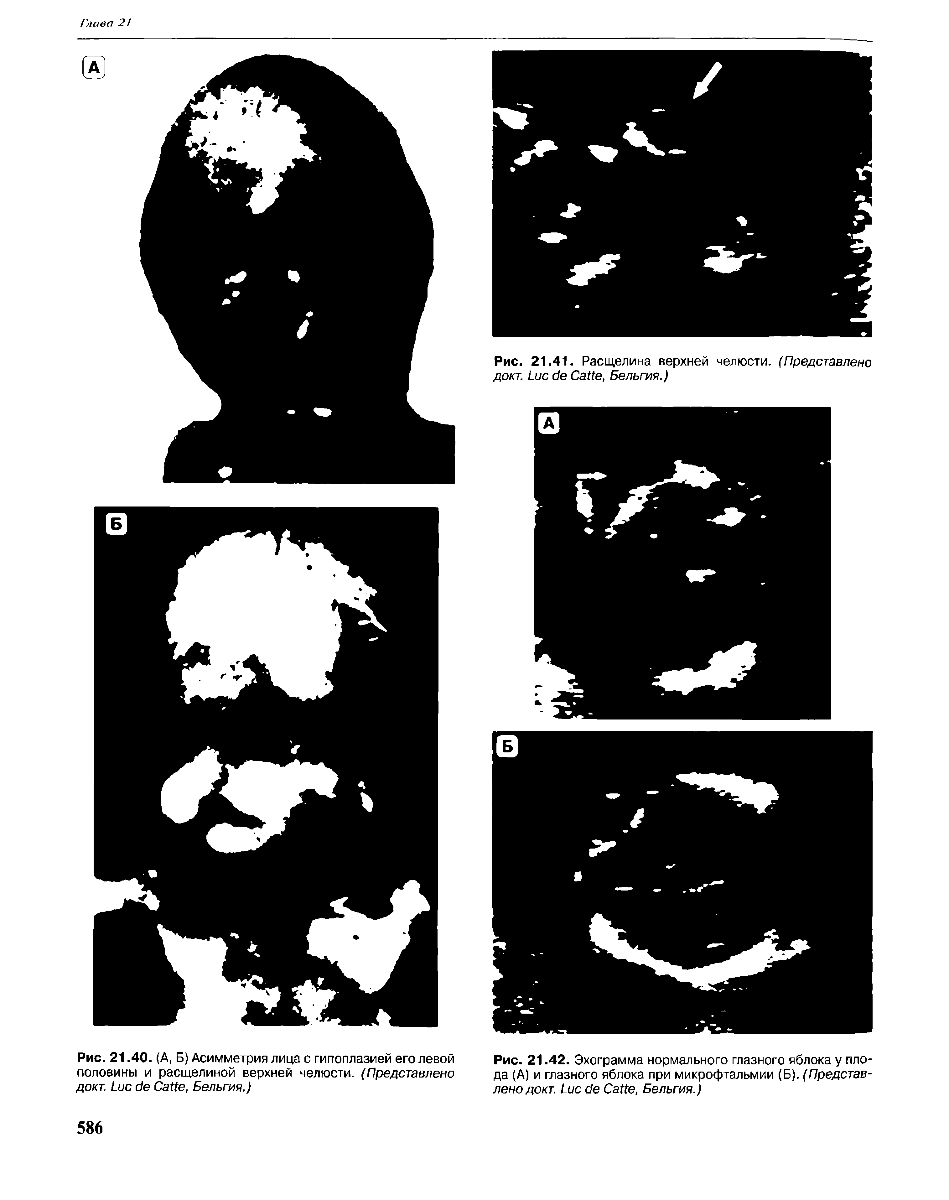 Рис. 21.40. (А, Б) Асимметрия лица с гипоплазией его левой половины и расщелиной верхней челюсти. (Представлено докт. L C , Бельгия.)...