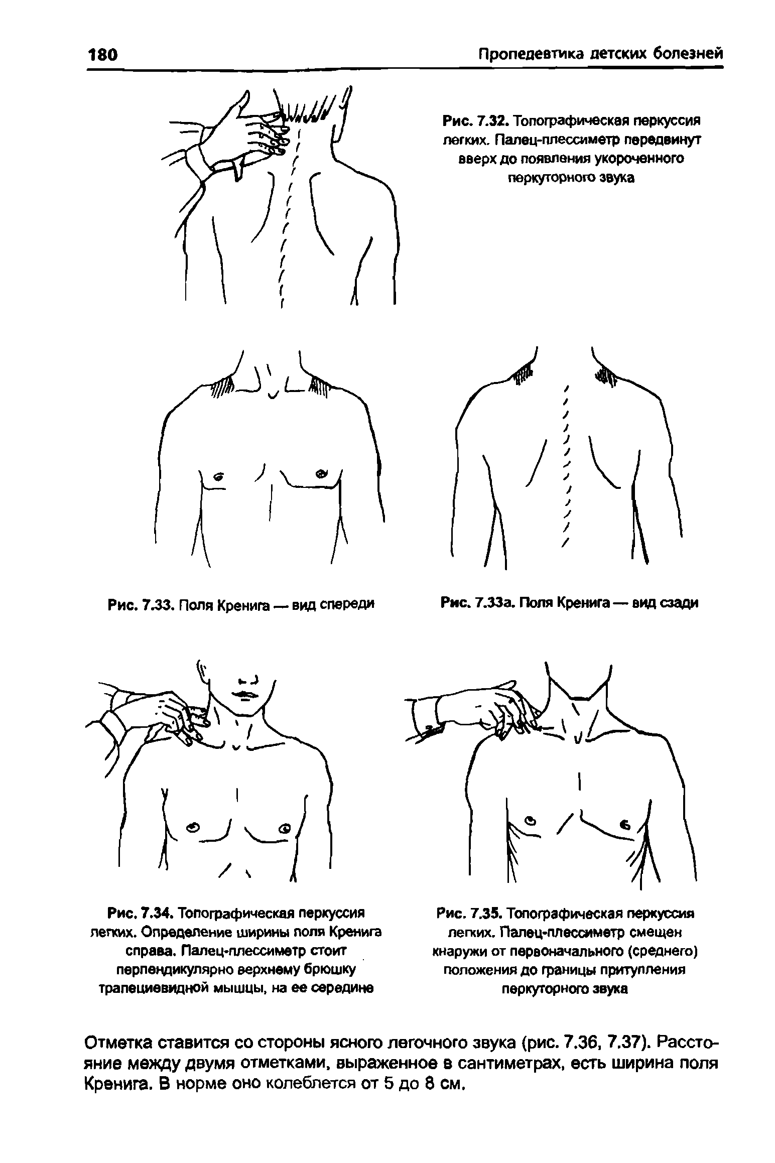 Рис. 7.34. Топографическая перкуссия легких. Определение ширины поля Кренига справа. Палец-плессиметр стоит перпендикулярно верхнему брюшку трапециевидной мышцы, на ее середине...