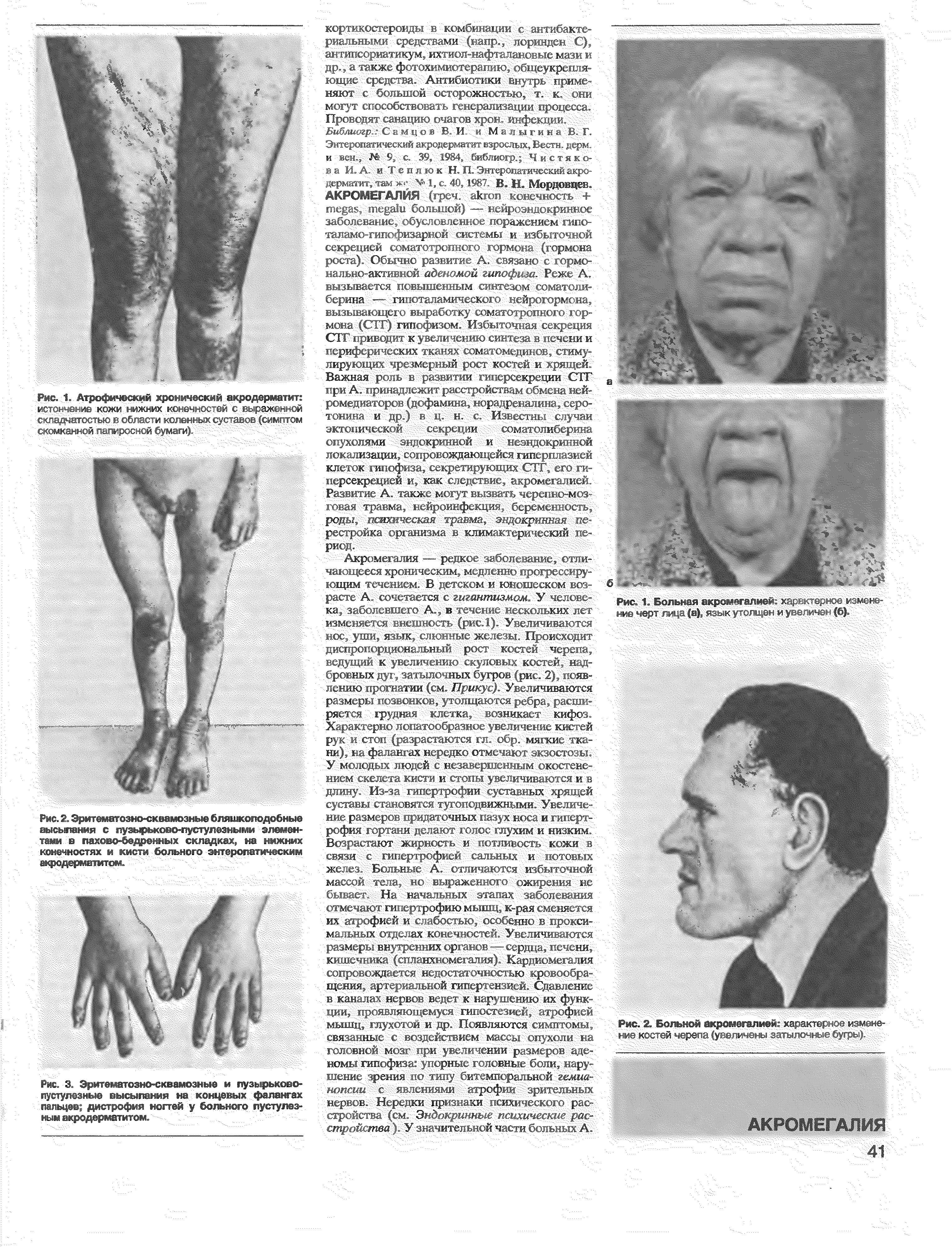 Рис. 2. Эритематозно-сквамозные бляшкоподобные высылания с пузырьково-пустулезными элементами в пахово-бедренных складках, на нижних конечностях и кисти больного энтеропатическим жродермат тр - - Т ...