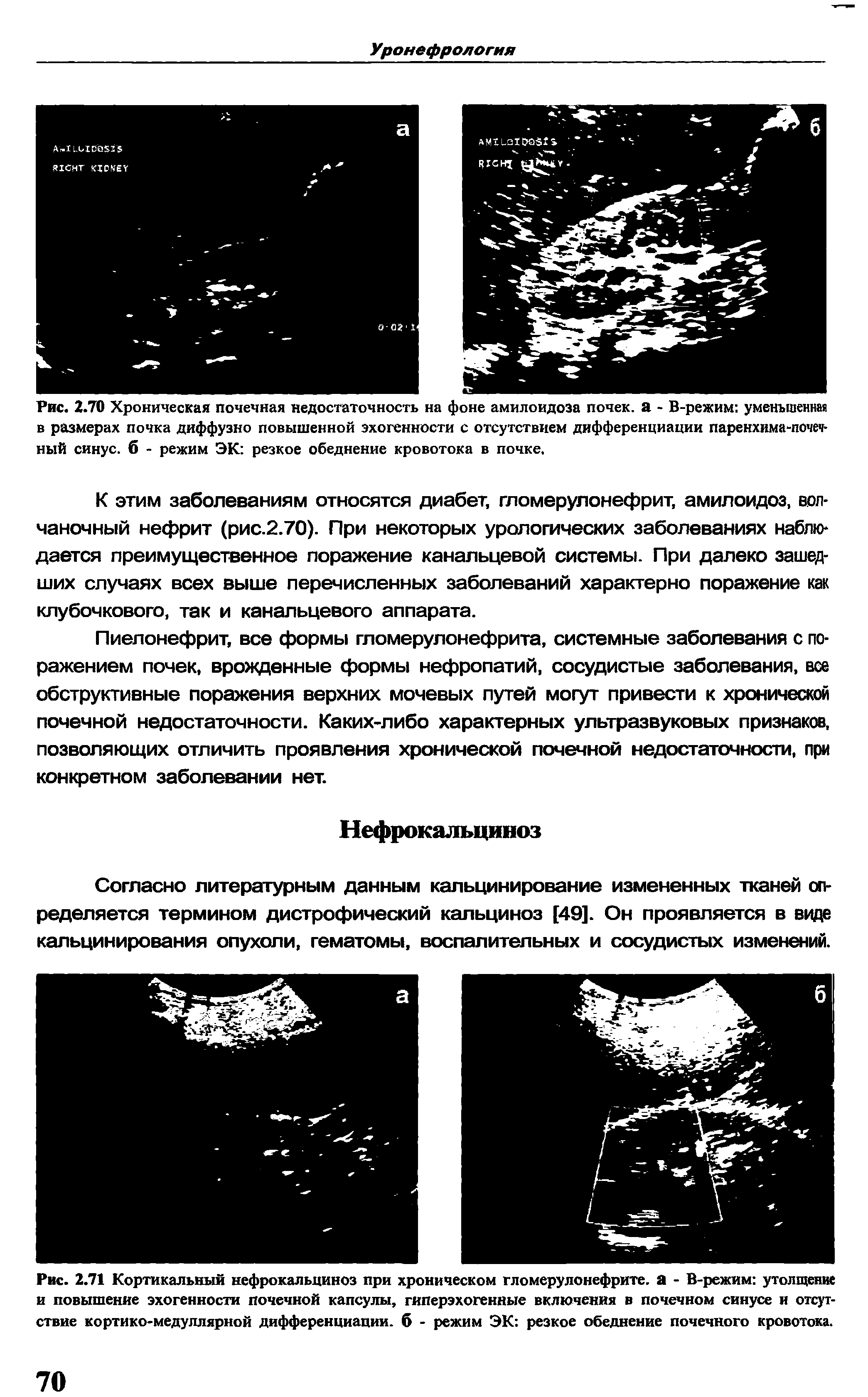 Рис. 2.71 Кортикальный нефрокальциноз при хроническом гломерулонефрите, а - В-режим утолщение и повышение эхогенности почечной капсулы, гиперэхогенные включения в почечном синусе и отсутствие кортико-медуллярной дифференциации, б - режим ЭК резкое обеднение почечного кровотока.