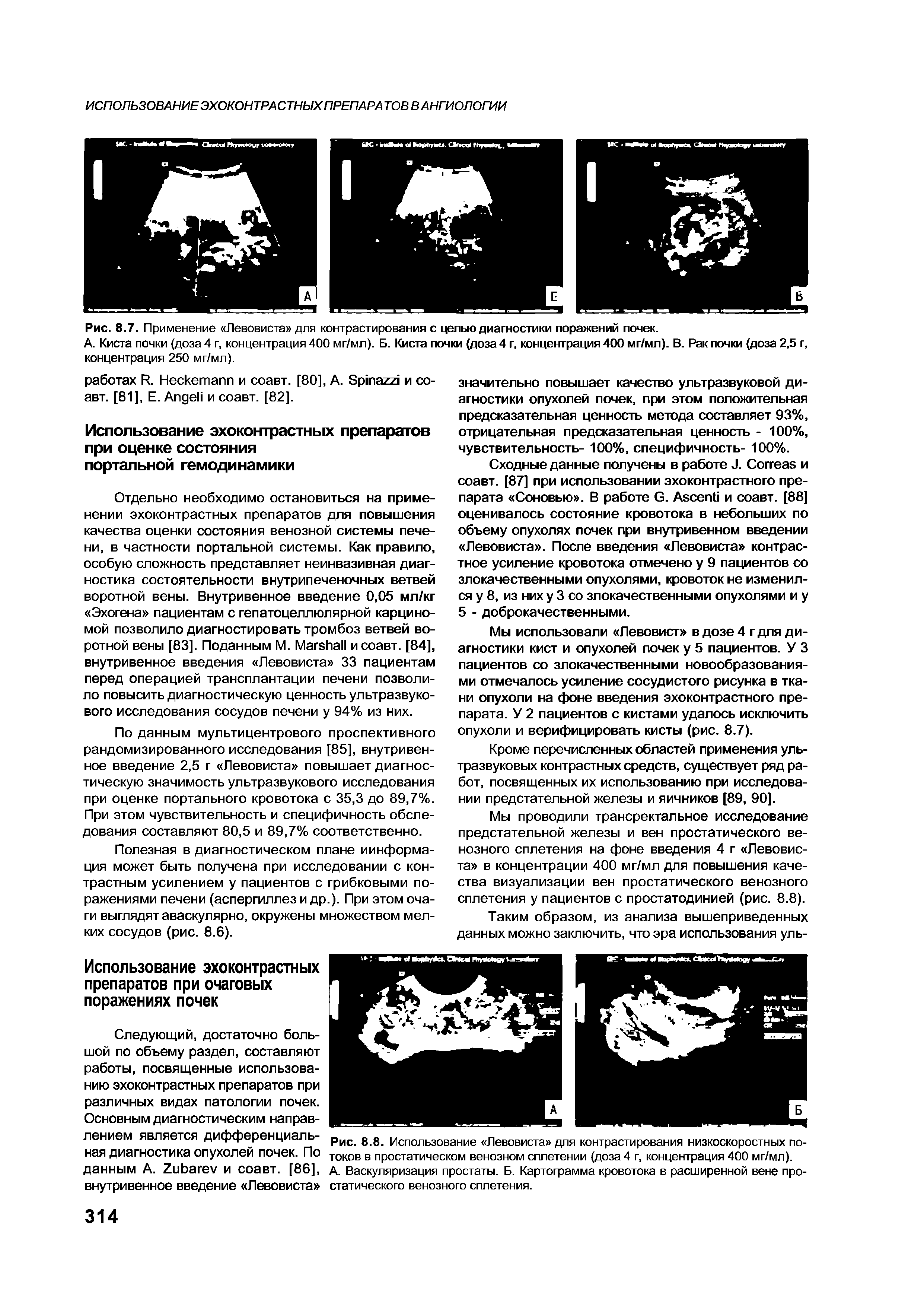 Рис. 8.8. Использование Левовиста для контрастирования низкоскоростных потоков в простатическом венозном сплетении (доза 4 г, концентрация 400 мг/мл).