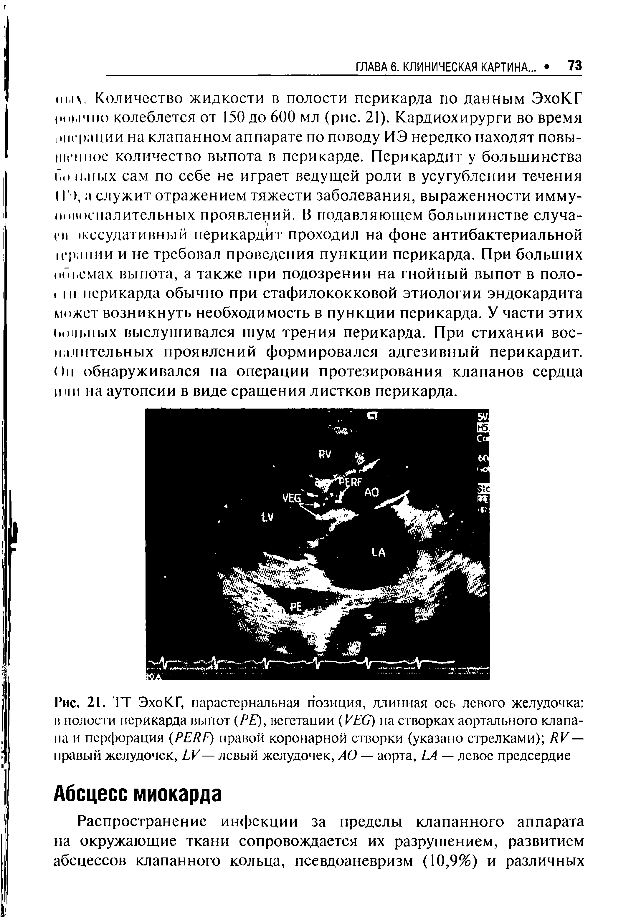 Рис. 21. ТТ ЭхоКГ, парастернальная позиция, длинная ось левого желудочка в полости перикарда выпот (РЕ), вегетации (VEG) па створках аортального клапана и перфорация (PERF) правой коронарной створки (указано стрелками) RE— правый желудочек, И — левый желудочек, АО — аорта, LA — левое предсердие...