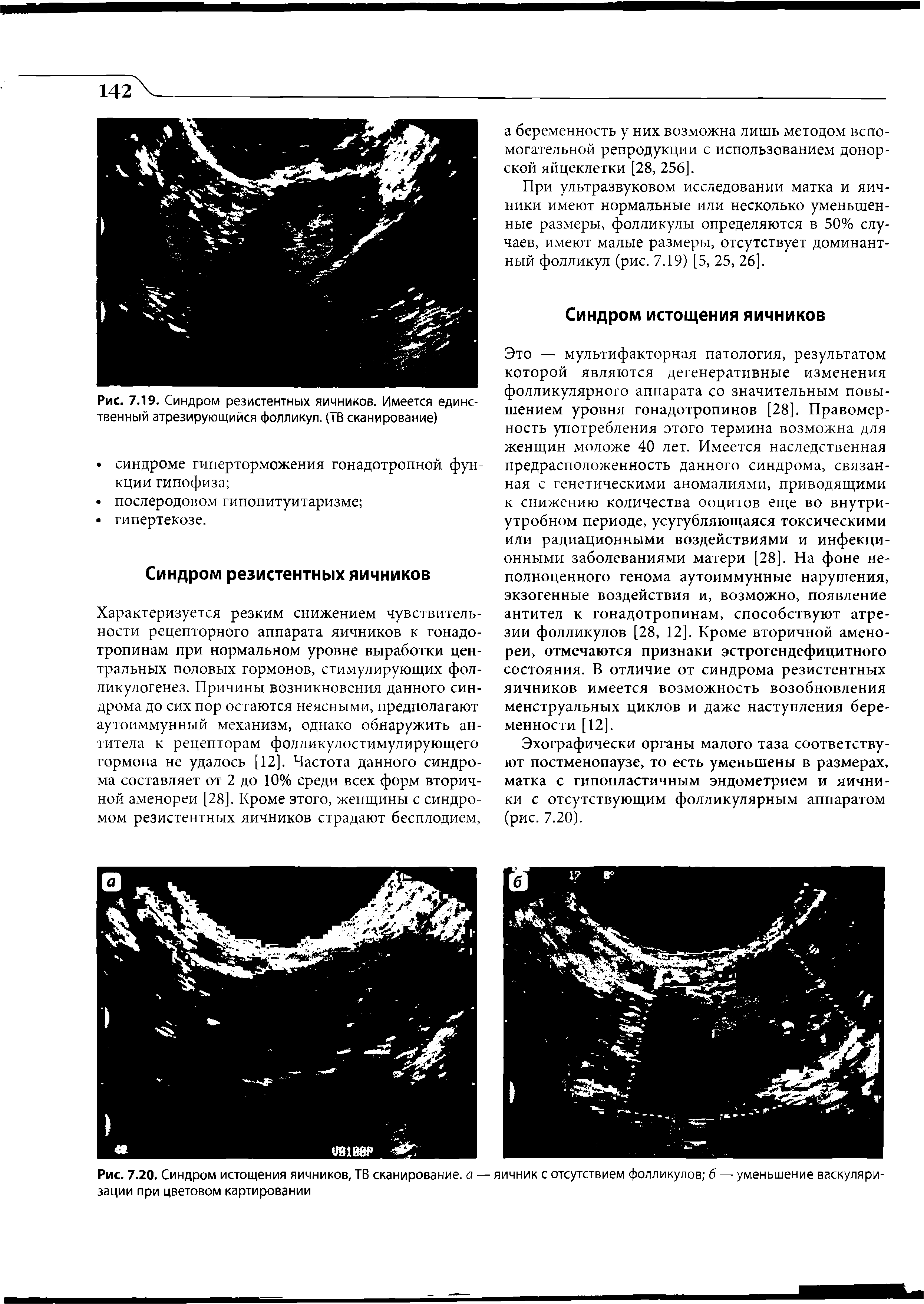 Рис. 7.20. Синдром истощения яичников, ТВ сканирование, а — яичник с отсутствием фолликулов б — уменьшение васкуляризации при цветовом картировании...