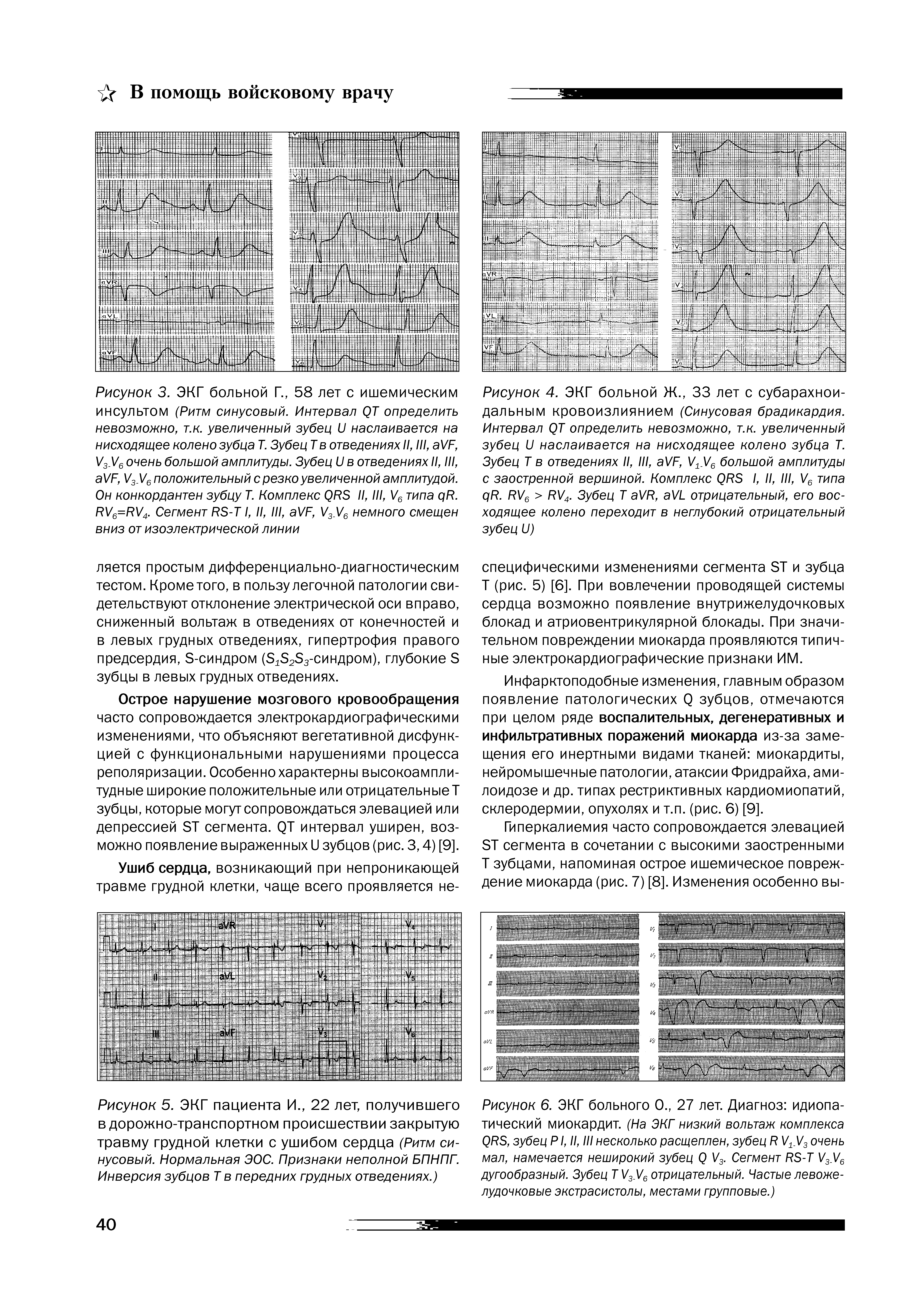 Рисунок 5. ЭКГ пациента И., 22 лет, получившего в дорожно-транспортном происшествии закрытую травму грудной клетки с ушибом сердца (Ритм синусовый. Нормальная ЭОС. Признаки неполной БПНПГ. Инверсия зубцов Т в передних грудных отведениях.)...