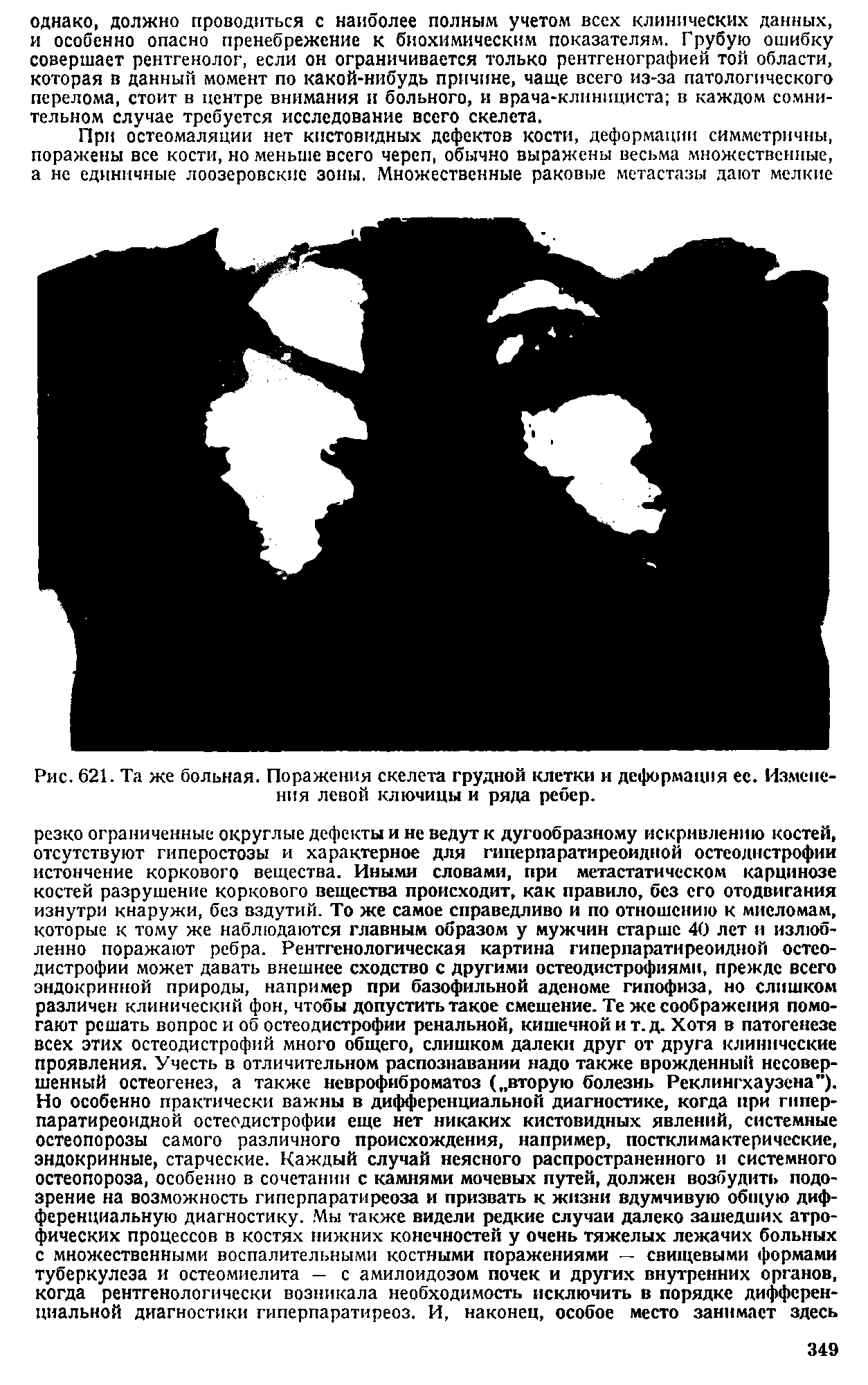 Рис. 621. Та же больная. Поражения скелета грудной клетки и деформация ее. Изменения левой ключицы и ряда ребер.