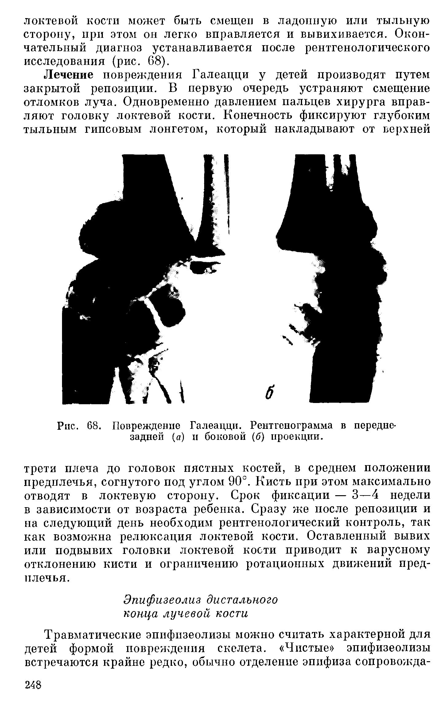 Рис. 68. Повреждение Галеацци. Рентгенограмма в переднезадней (а) и боковой (б) проекции.