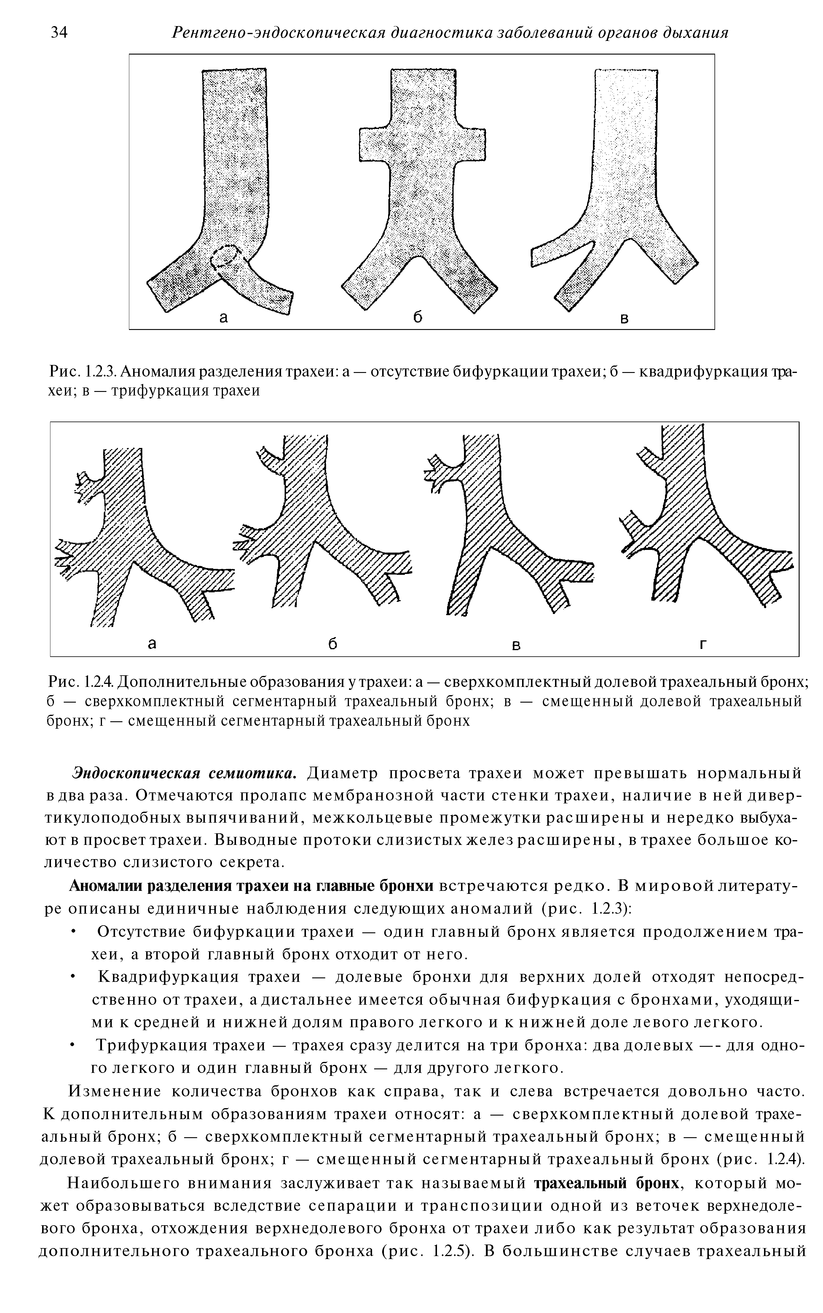 Рис. 1.2.4. Дополнительные образования у трахеи а — сверхкомплектный долевой трахеальный бронх б — сверхкомплектный сегментарный трахеальный бронх в — смещенный долевой трахеальный бронх г — смещенный сегментарный трахеальный бронх...