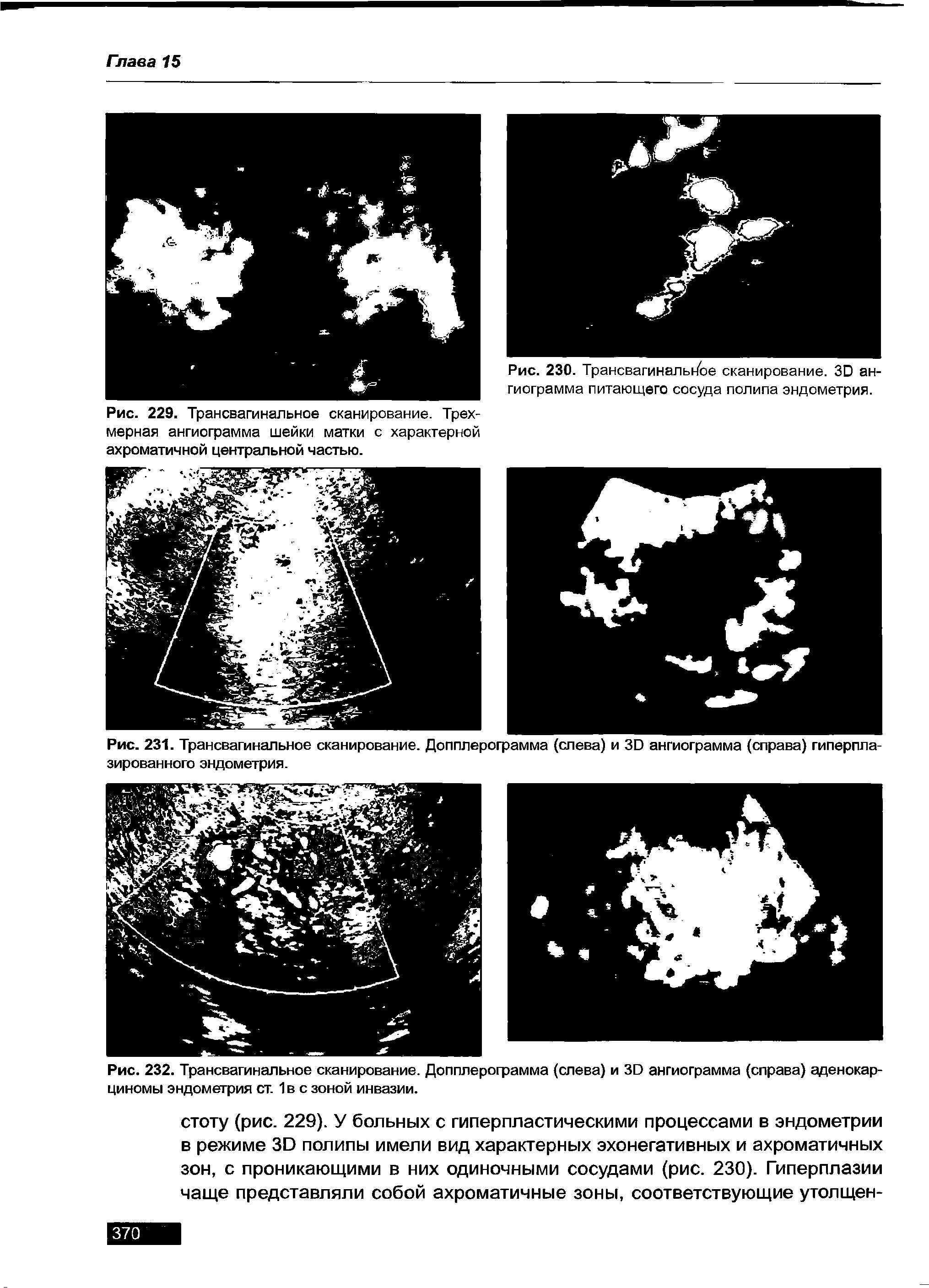 Рис. 229. Трансвагинальное сканирование. Трехмерная ангиограмма шейки матки с характерной ахроматичной центральной частью.