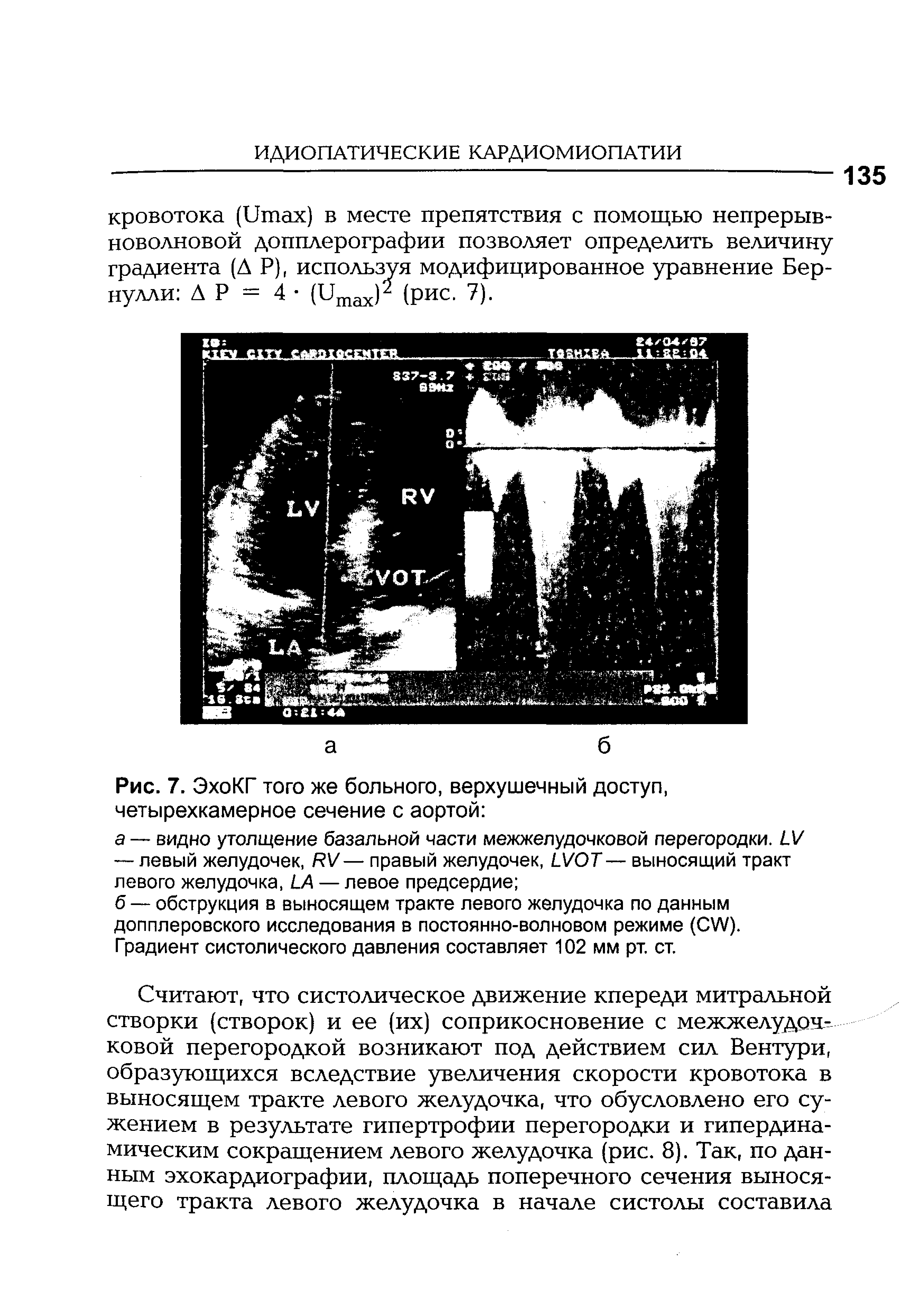 Рис. 7. ЭхоКГ того же больного, верхушечный доступ, четырехкамерное сечение с аортой ...