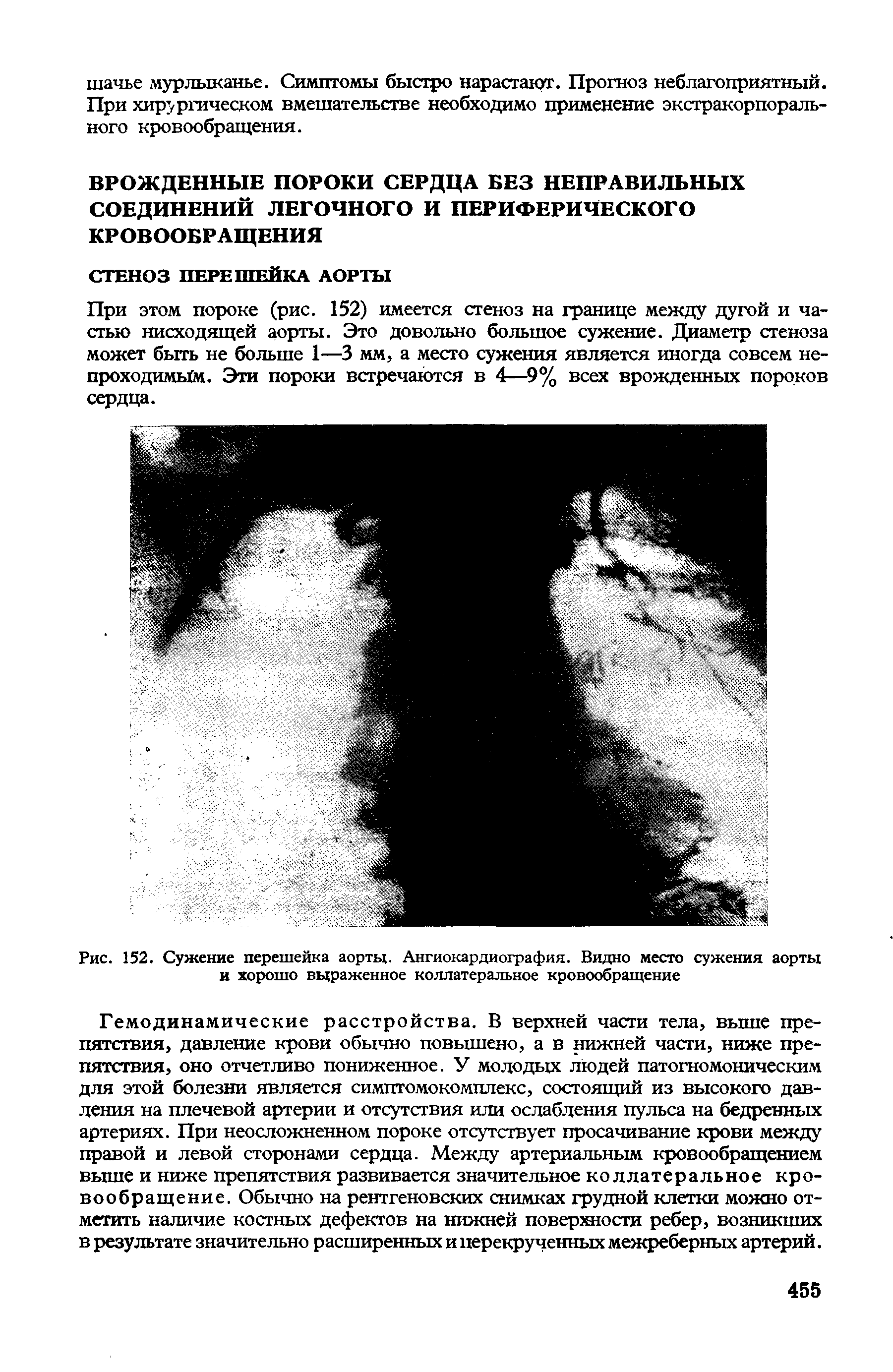 Рис. 152. Сужение перешейка аорты. Ангиокардиография. Видно место сужения аорты и хорошо выраженное коллатеральное кровообращение...