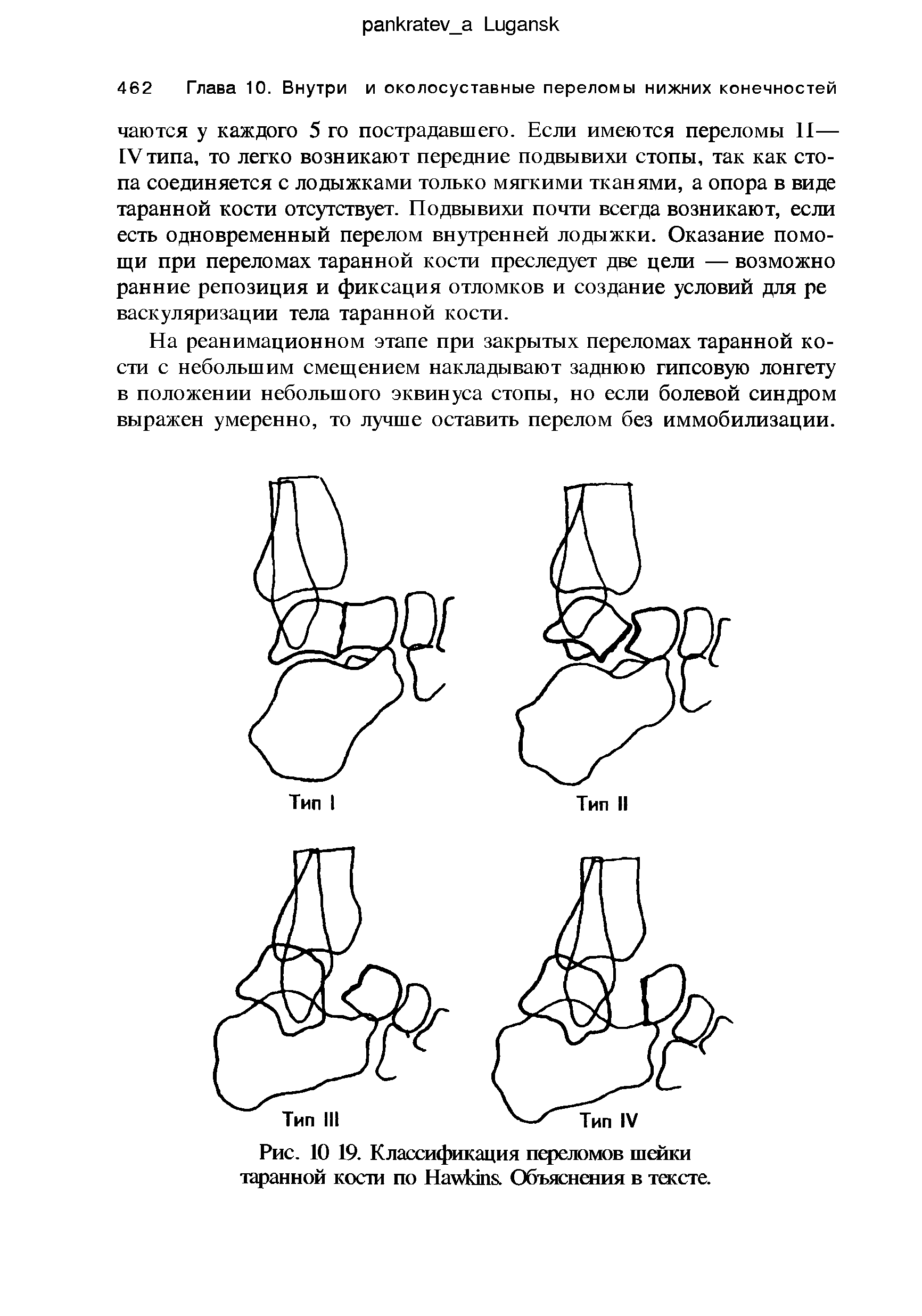 Рис. 10 19. Классификация переломов шейки таранной кости по H . Объяснения в тексте.