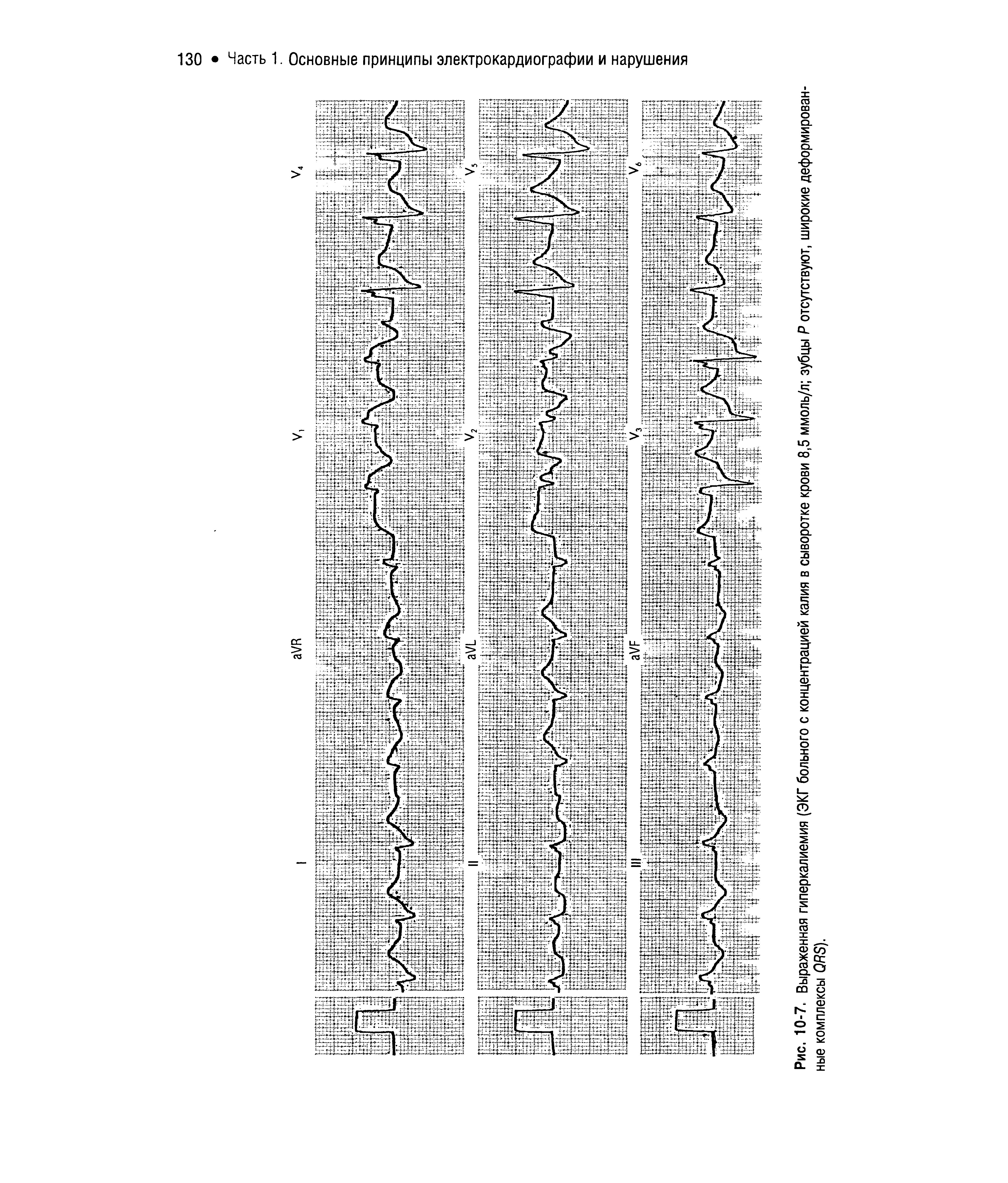 Рис. 10-7. Выраженная гиперкалиемия (ЭКГ больного с концентрацией калия в сыворотке крови 8,5 ммоль/л зубцы Р отсутствуют, широкие деформированные комплексы ОЯЭ).