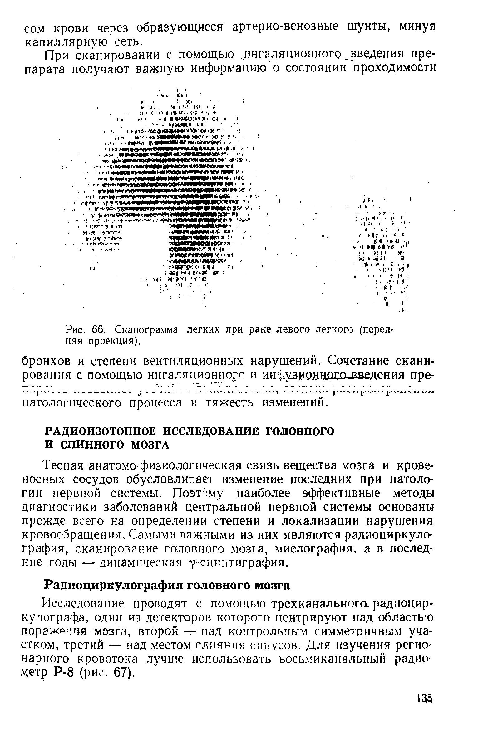 Рис. 66. Сканограмма легких при раке левого легкого (передняя проекция).