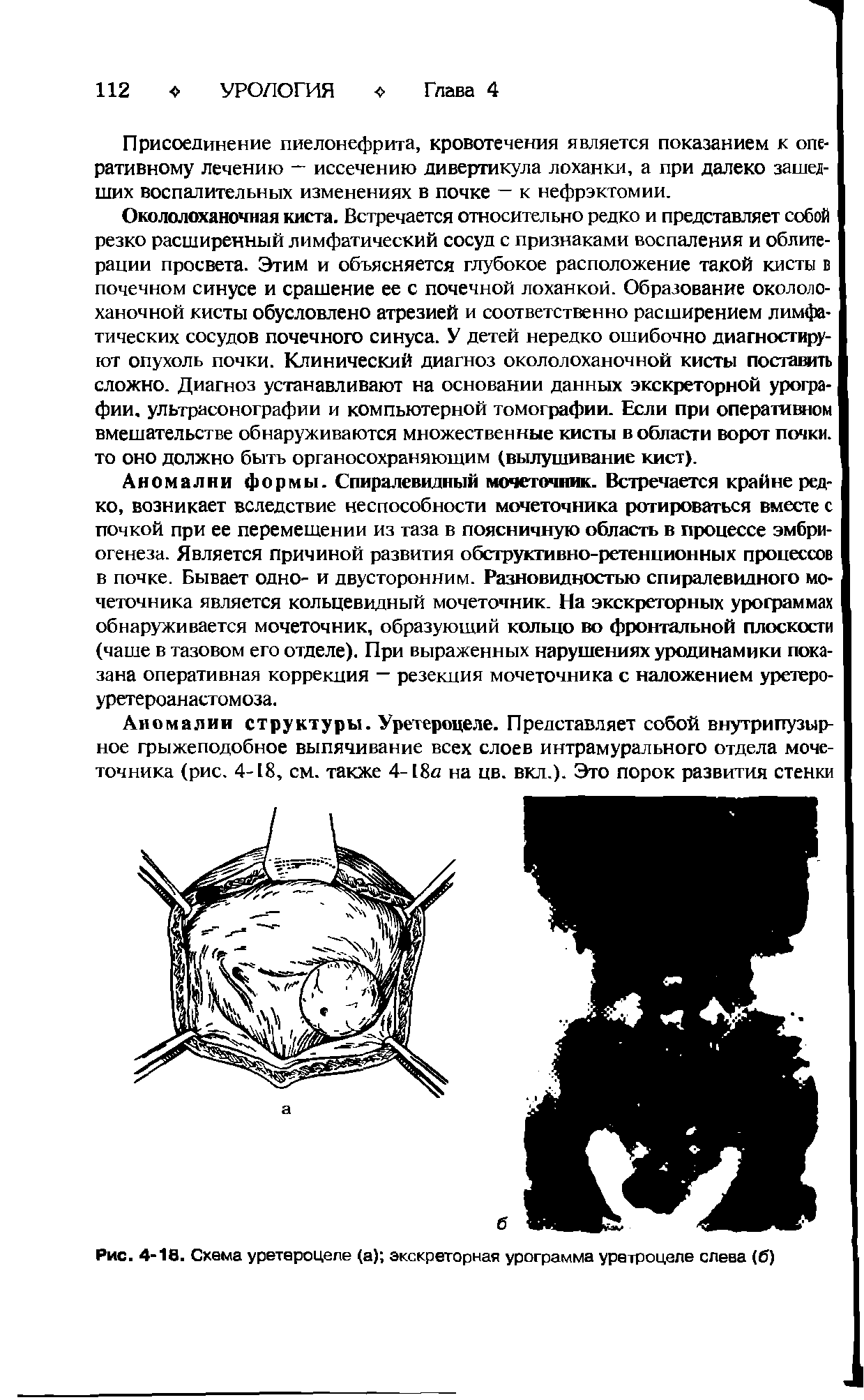 Рис. 4-10. Схема уретероцеле (а) экскреторная урограмма уретроцеле слева (б)...